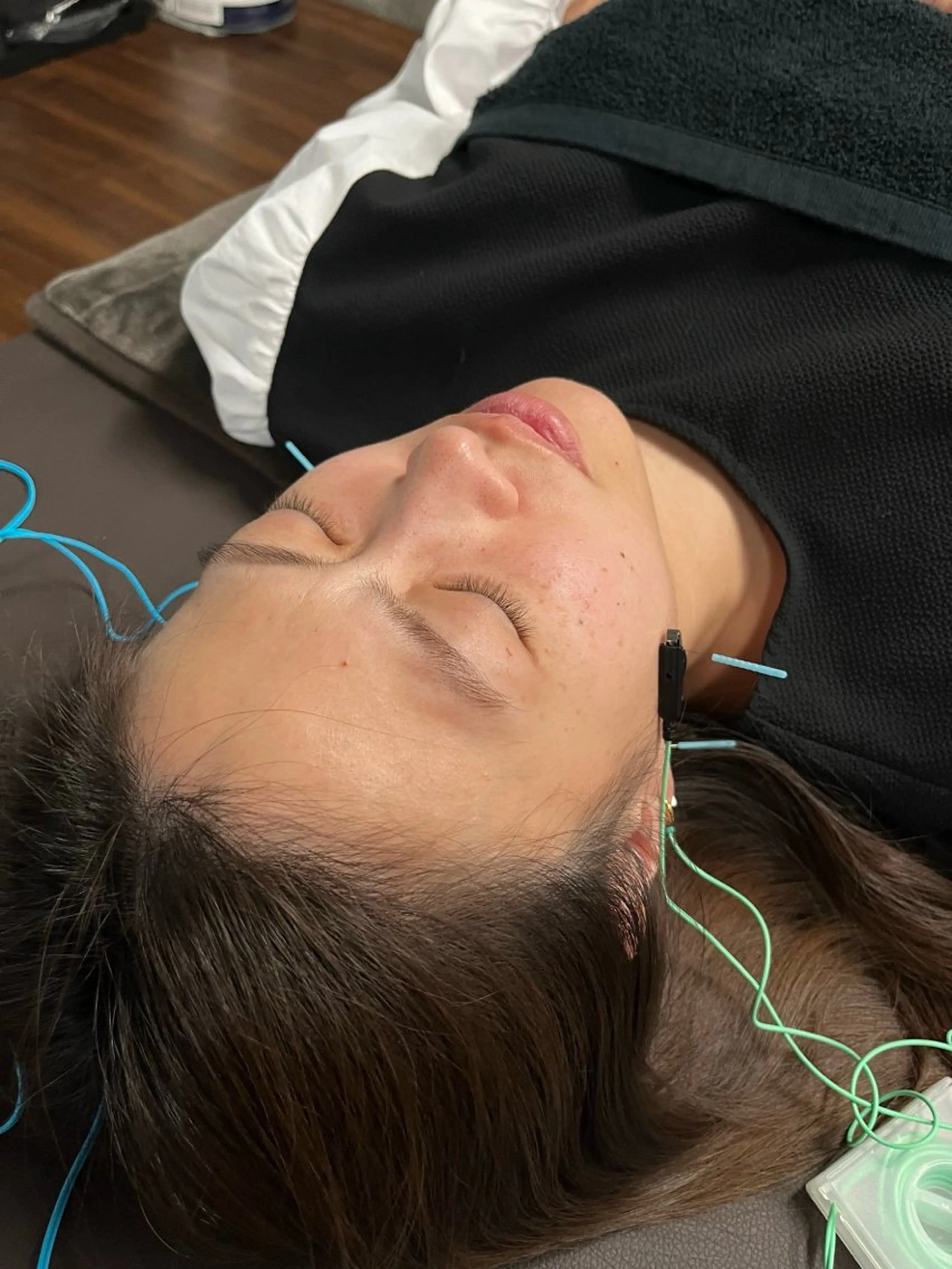 【美容鍼】⚡お顔の神経にダイレクトアプローチ🪡少ない本数×微弱電流で、負担を抑えつつ最大の美肌効果を実感♪の写真