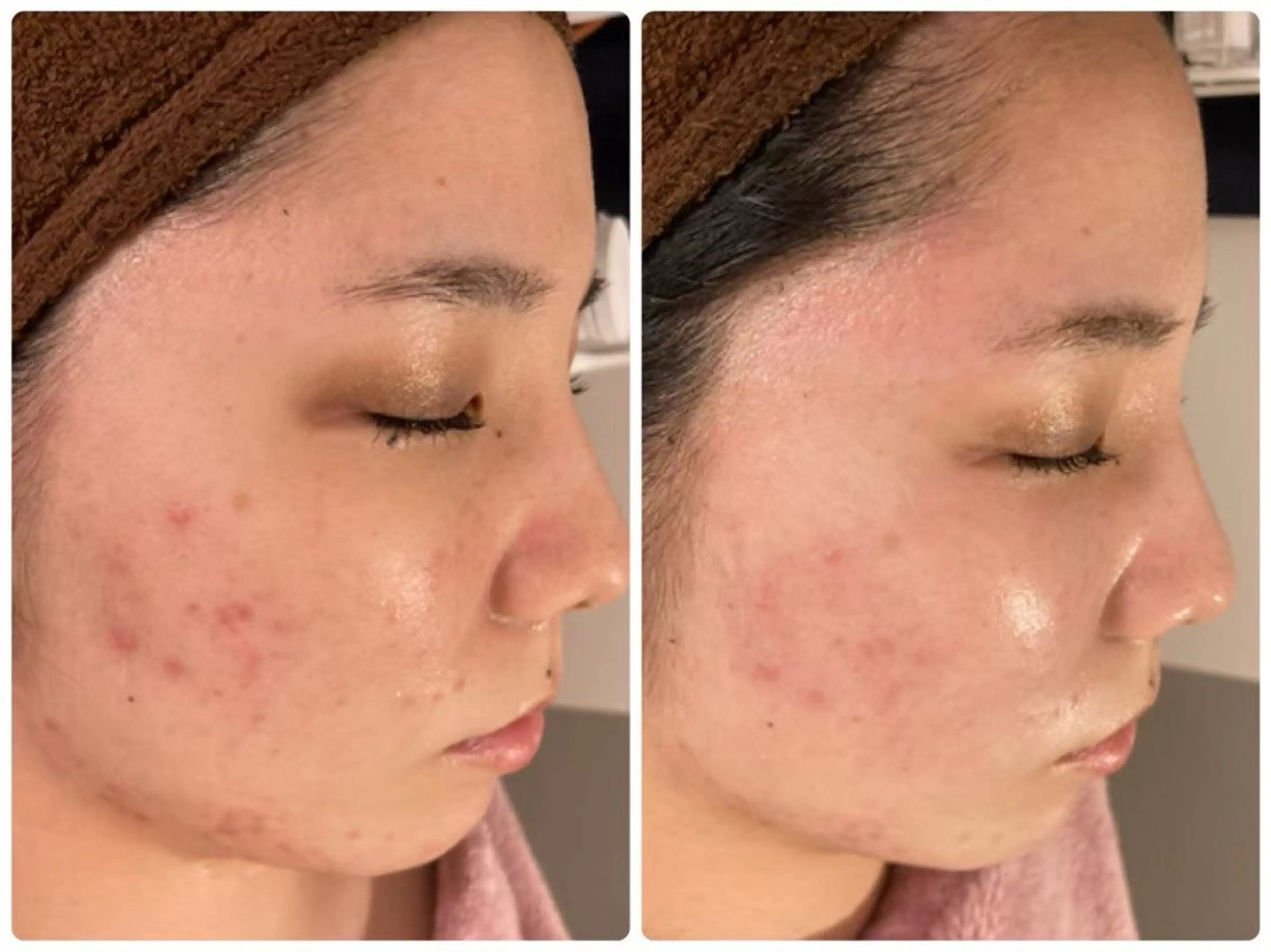 ニキビ･毛穴悩み特化 /CHISATOのエステ・リラクイメージ