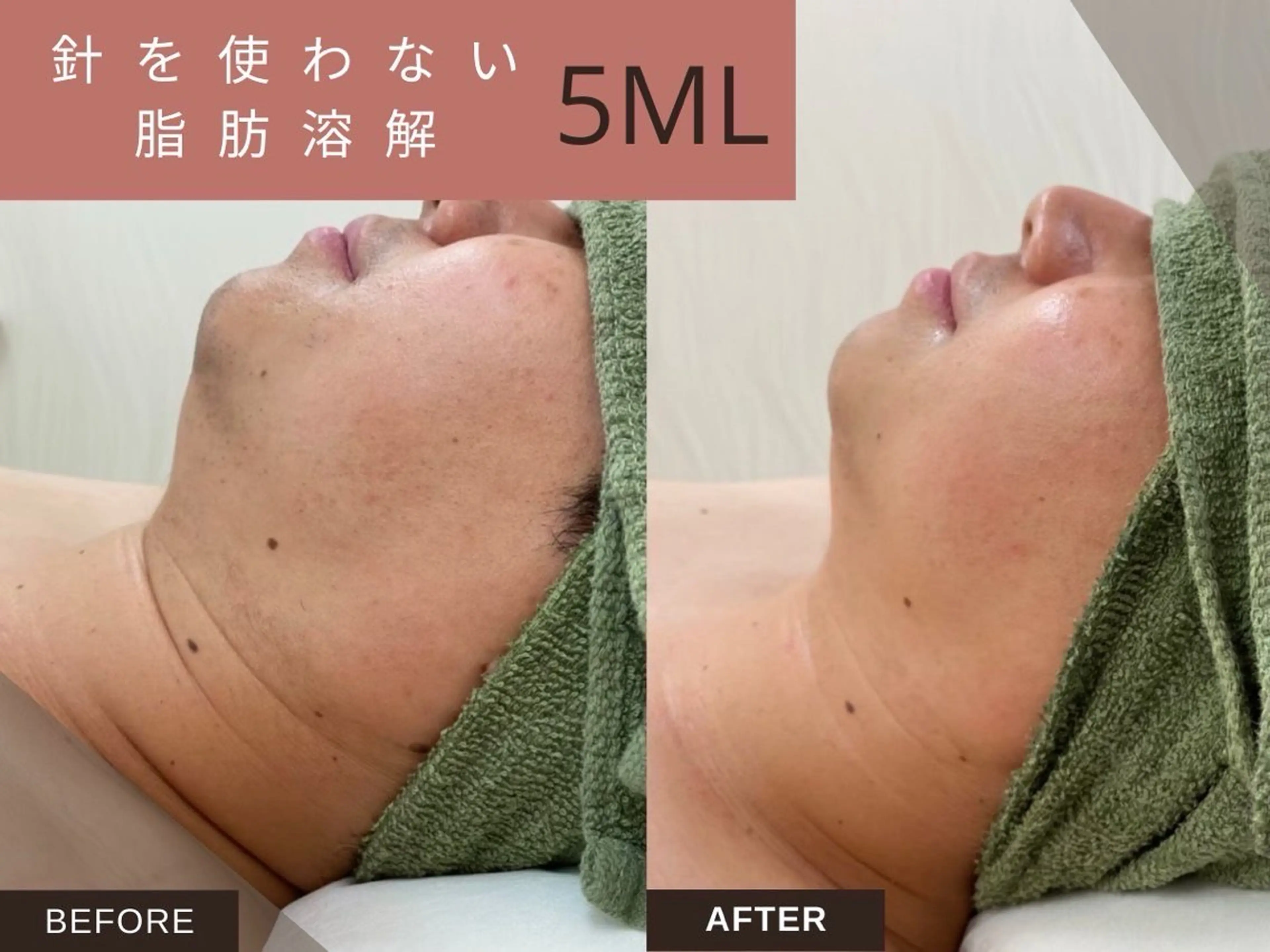 🍁モニター🍁針を使わない脂肪撃退【お顔】の写真