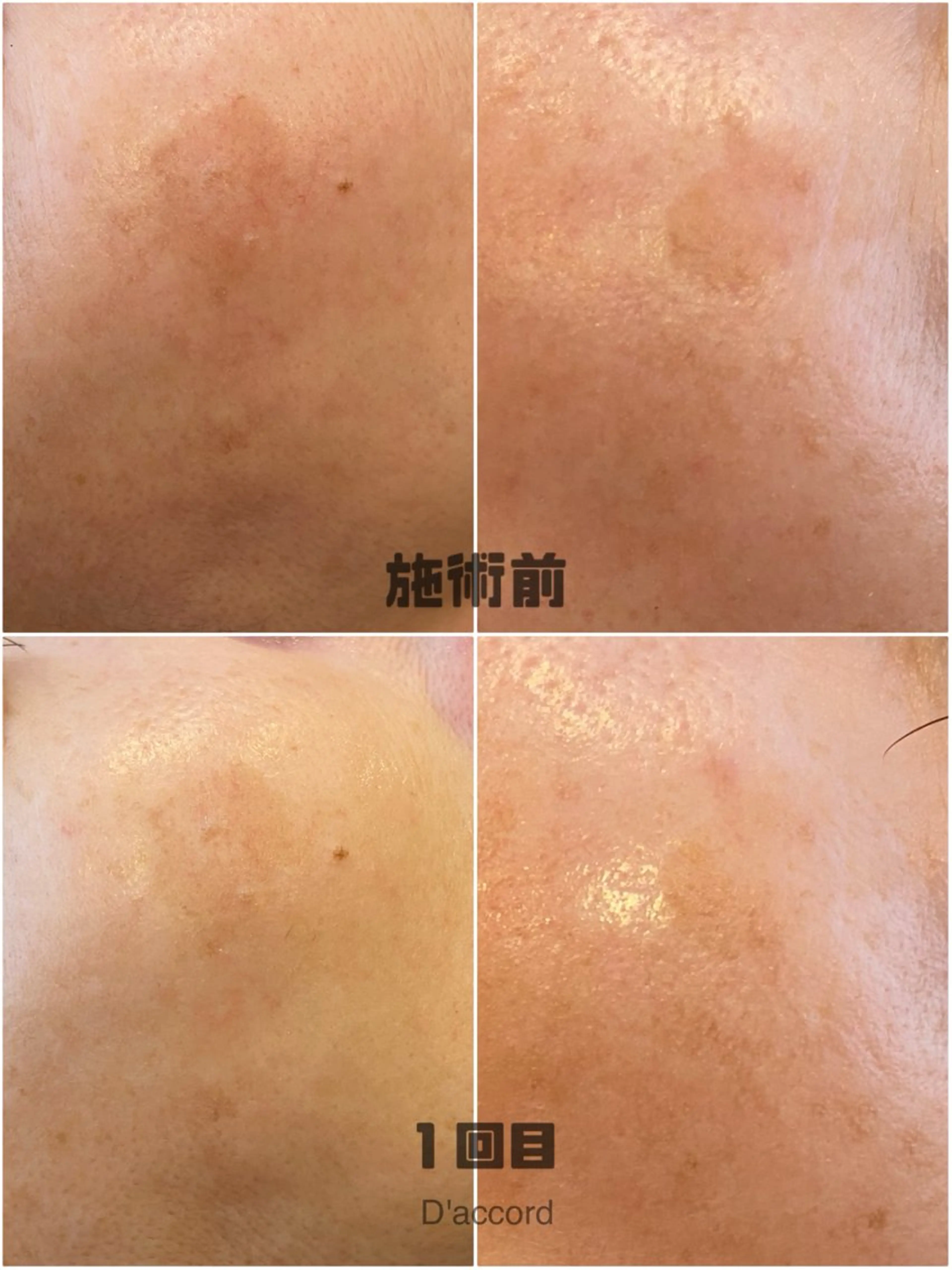 エステ D’accord Rikoのネイルデザイン