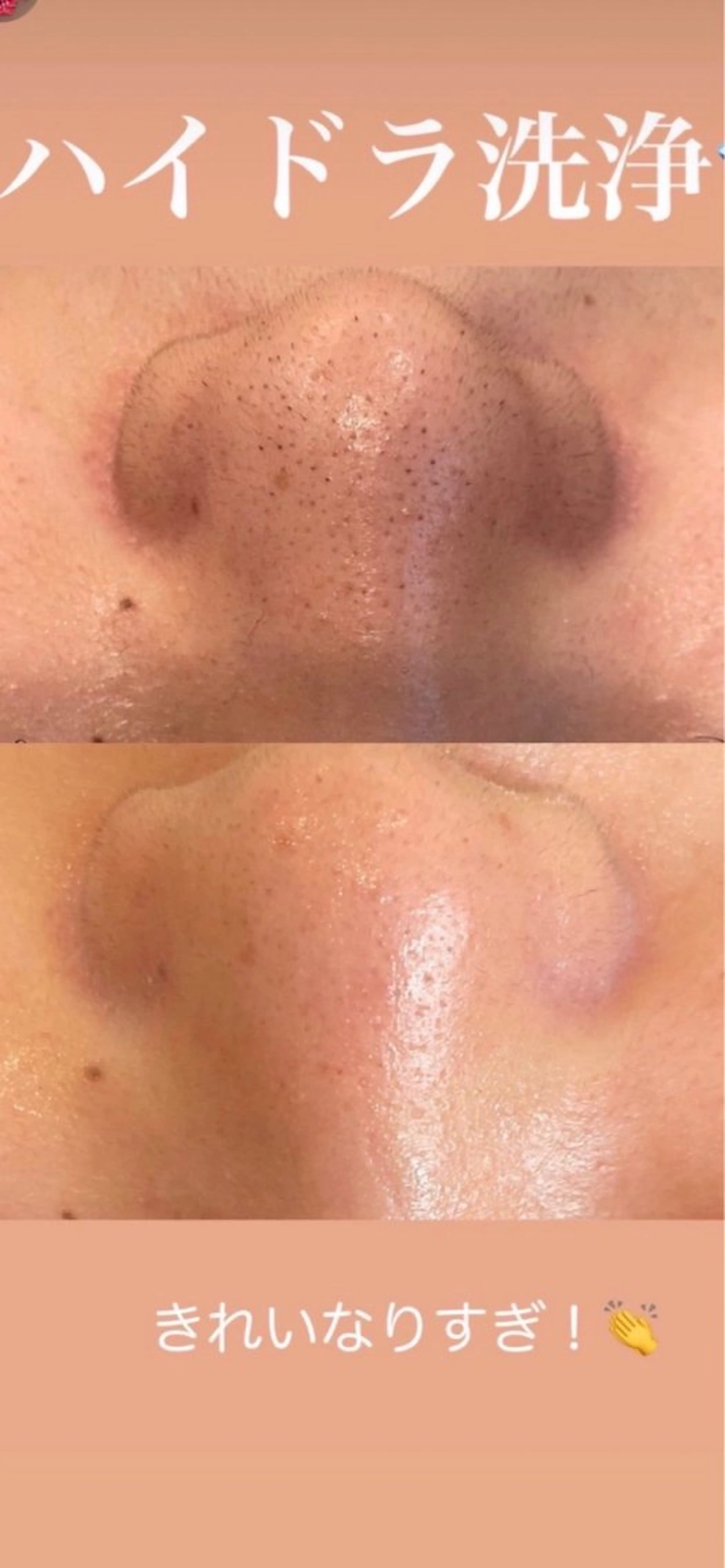毛穴洗浄の写真