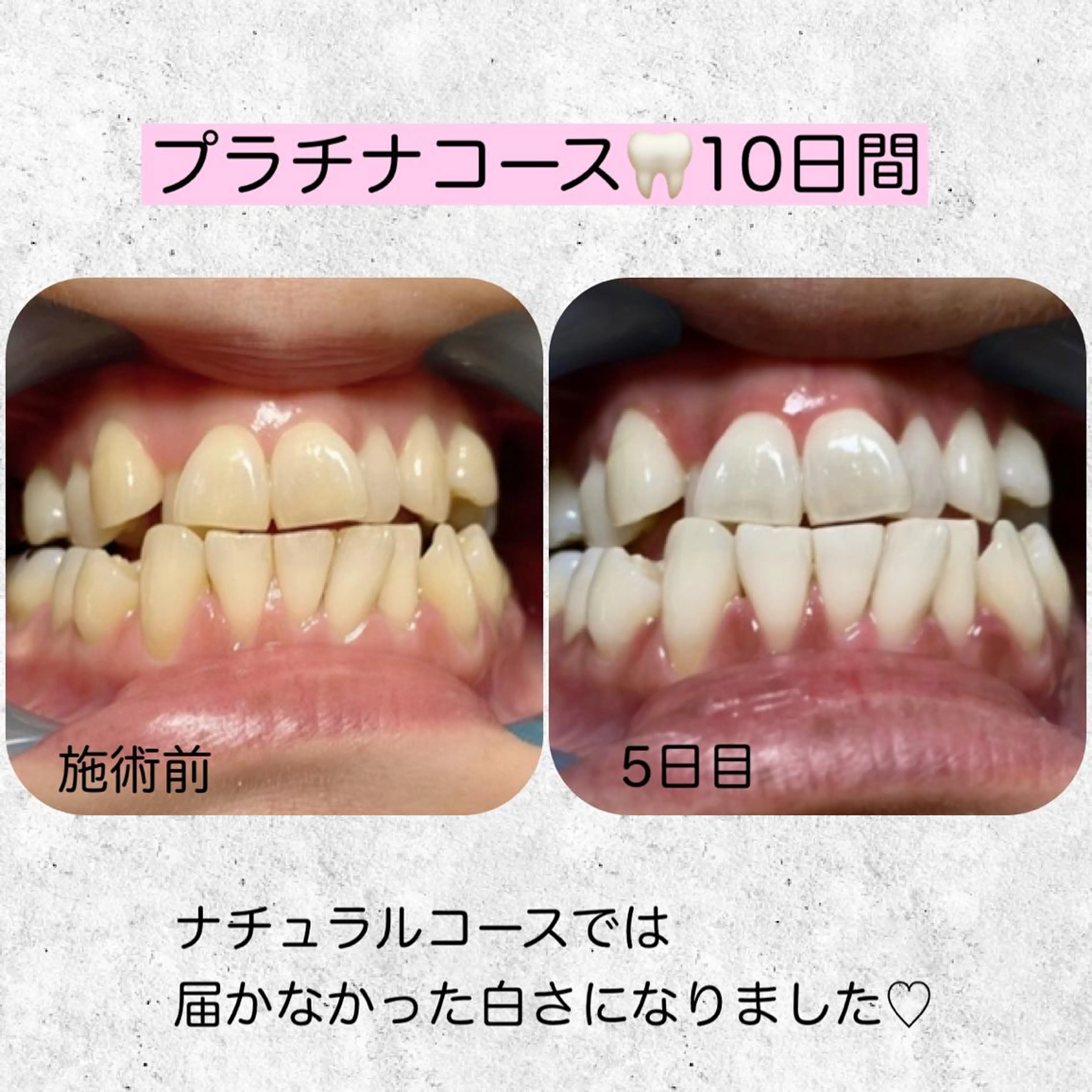 ネイル/耳つぼ /新ホワイトニングのネイルデザイン