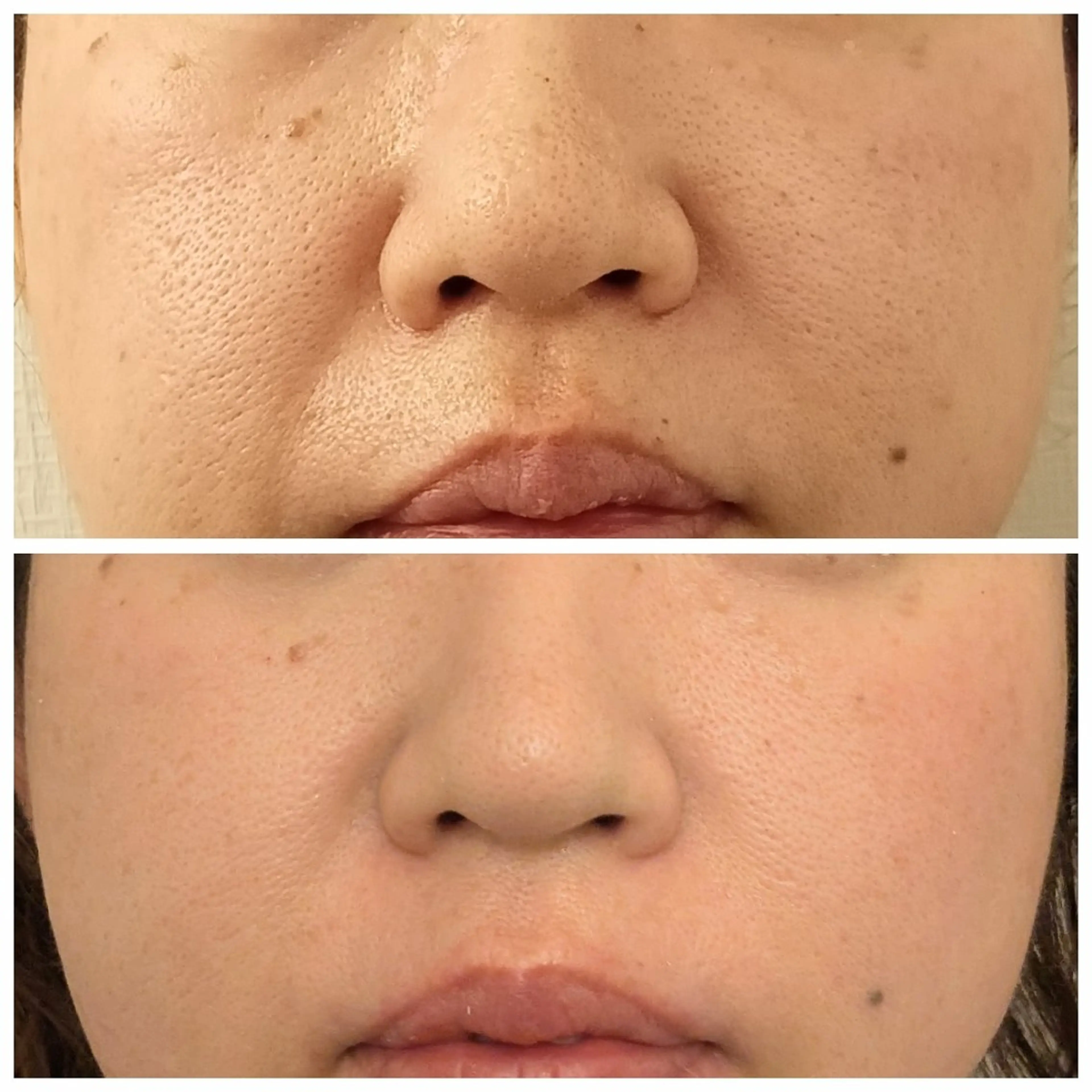 水光肌ピーリング ハーブピーリングのエステ・リラクイメージ