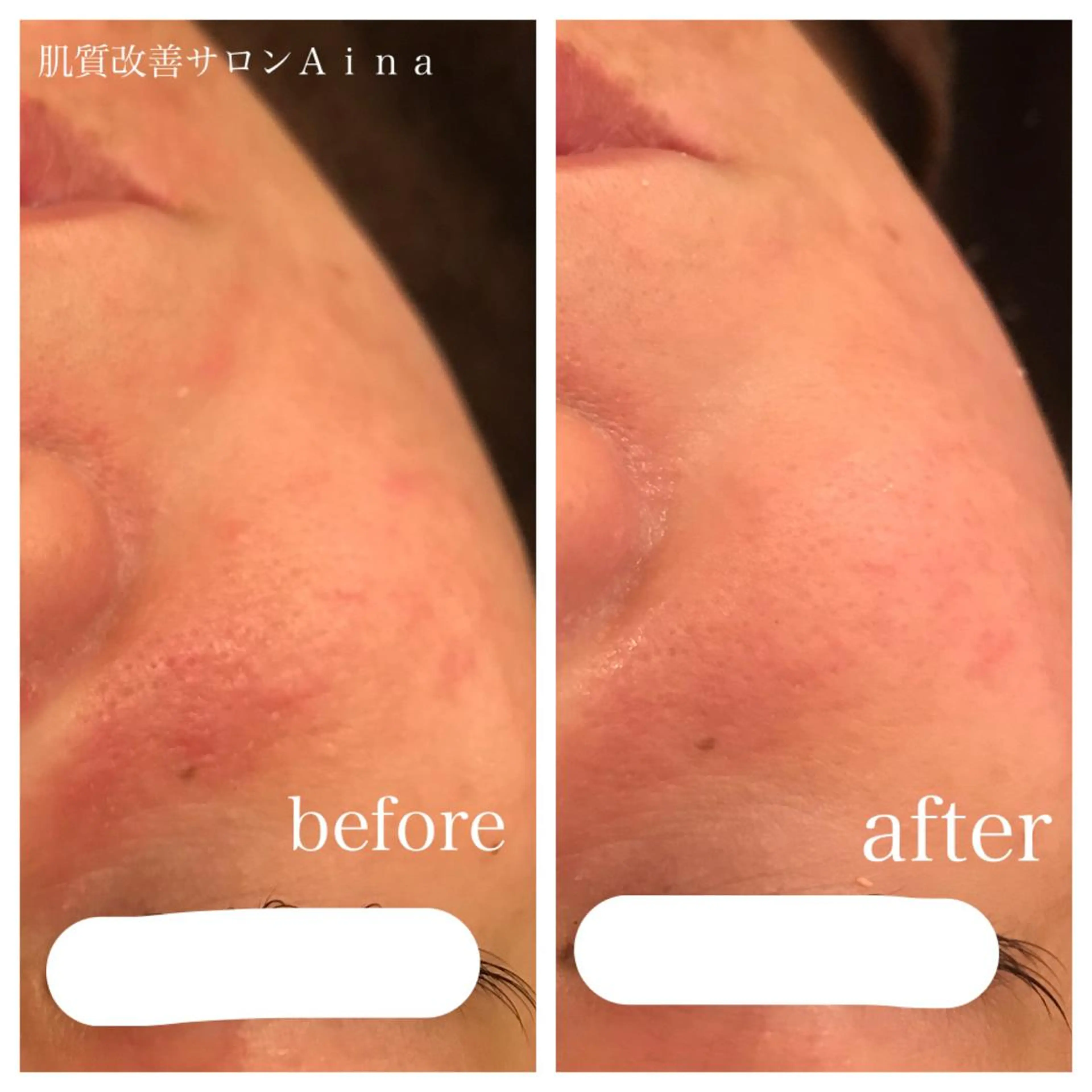 セミロング パーマ キッズ ネイル マツエク・マツパ エステ リラク ニキビ跡専門サロン Ａｉｎａのエステ・リラクイメージ