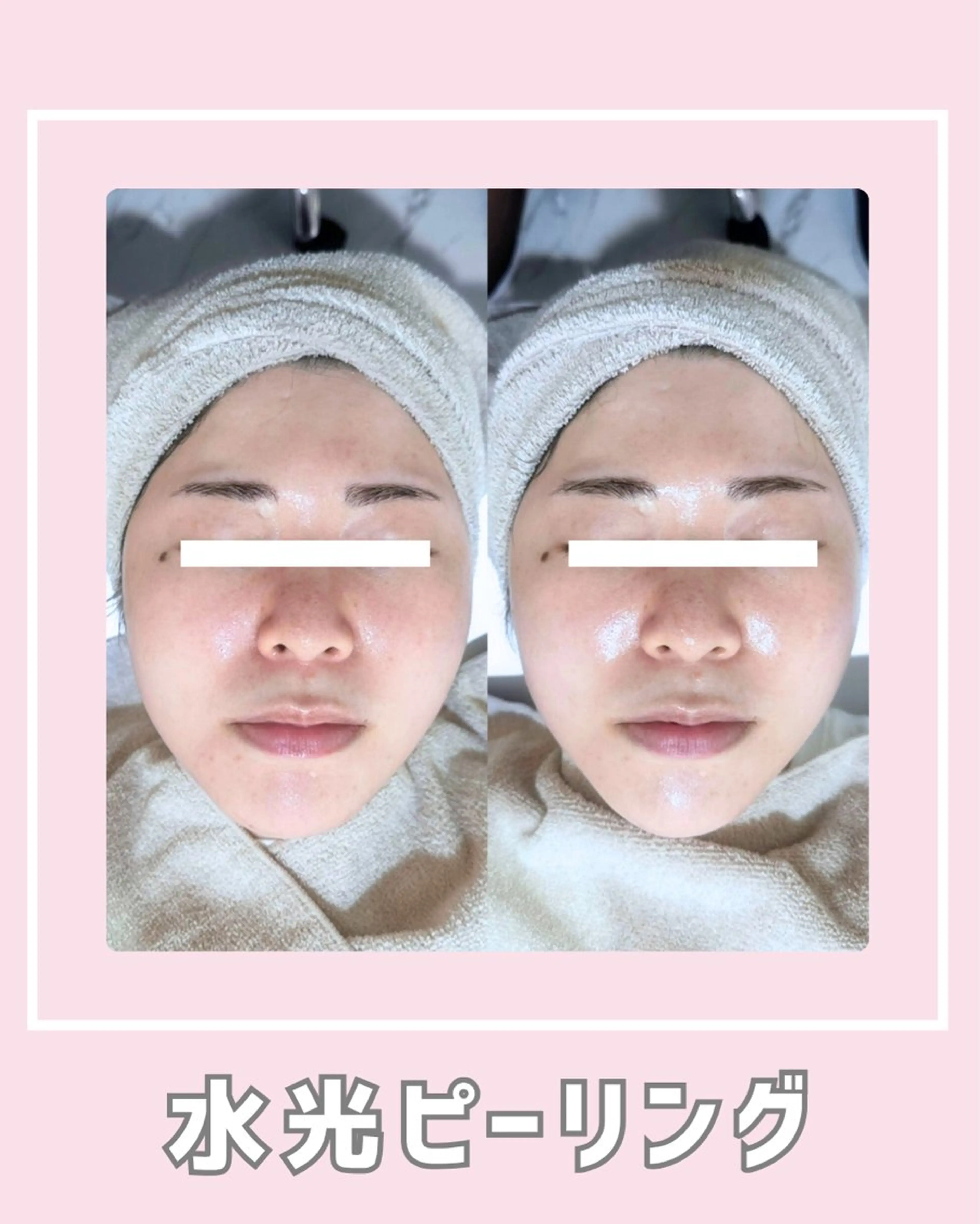 エステ |ピーリング・毛穴| soina神楽坂のエステ・リラクイメージ