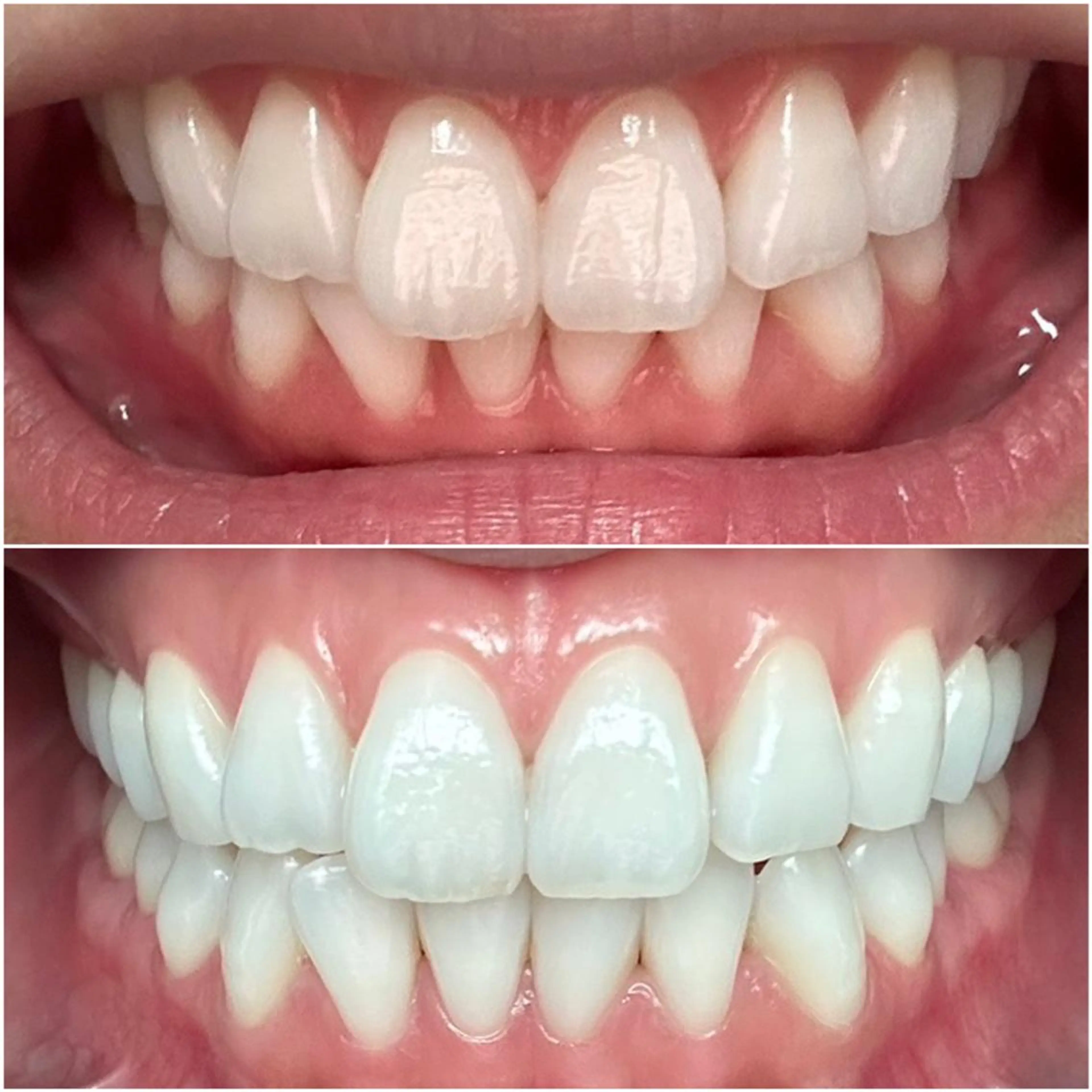 【歯の黄ばみに】ホワイトニング20分コース（☆歯の色が本当に白くなるの写真