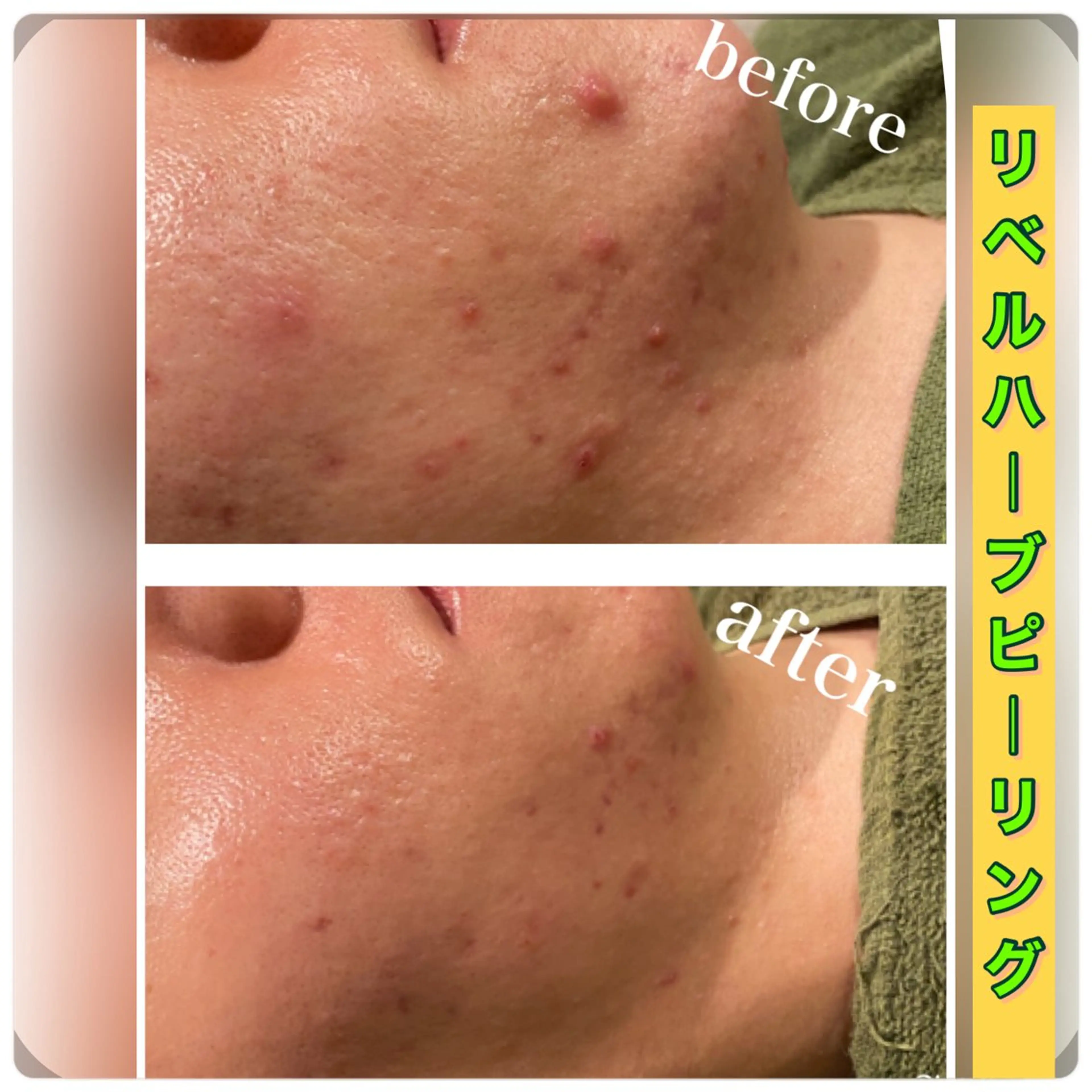 エステ 【リベルハーブピーリング認定店】敏感肌・美白脱毛専門店Dione立川店所属・Dione 立川店のエステ・リラクイメージ