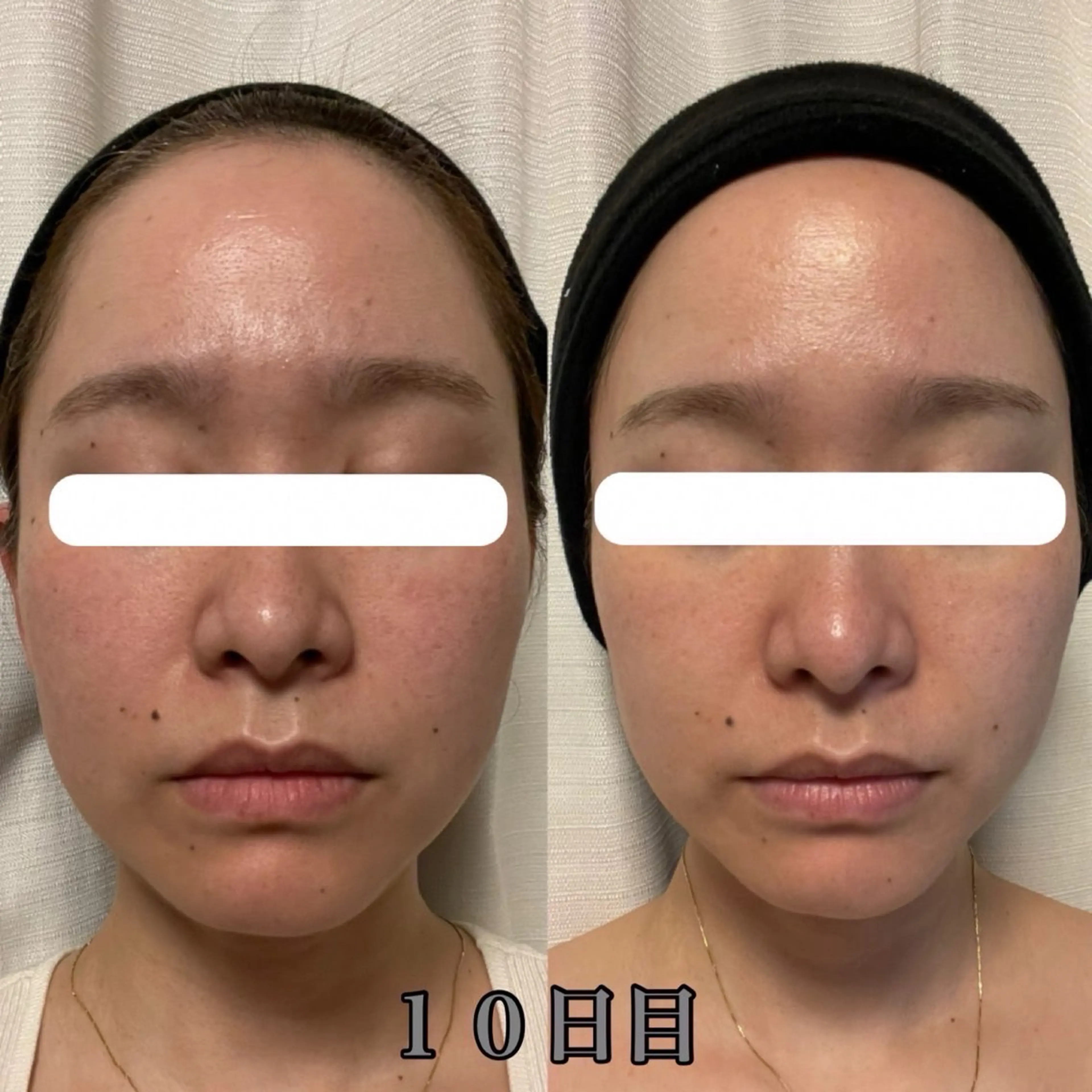 【頭・お顔整う】眠れるヘッドスパ（超高濃度ヒト幹細胞炭酸ガスパック付き）　肌荒れ、くすみ、赤みお悩みの方おすすめの写真