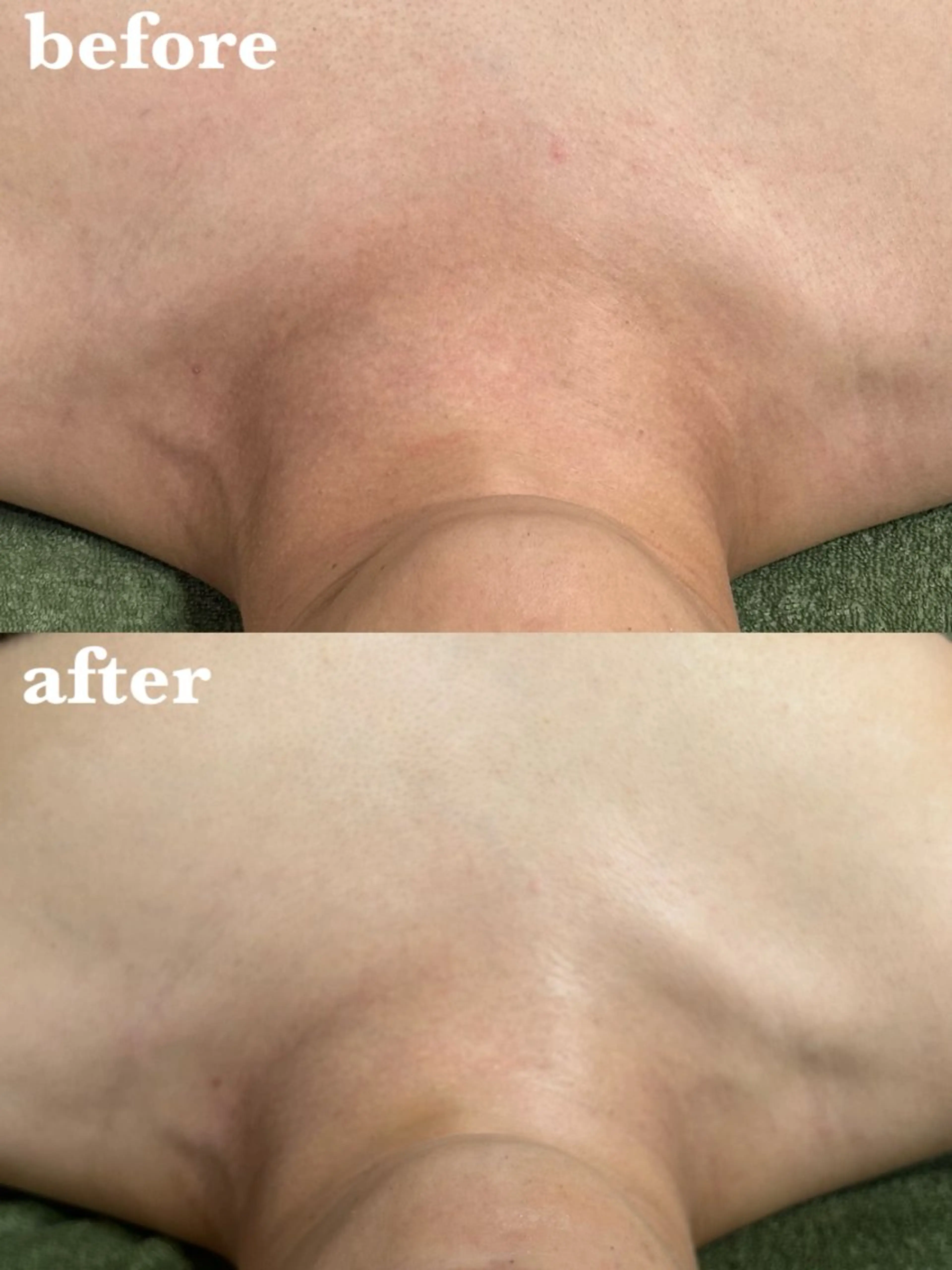 【肌ケア・痩身】陶肌トリートメント｢お顔｣+｢デコルテ｣(陶肌パウダー1ｇプレゼント価格)の写真