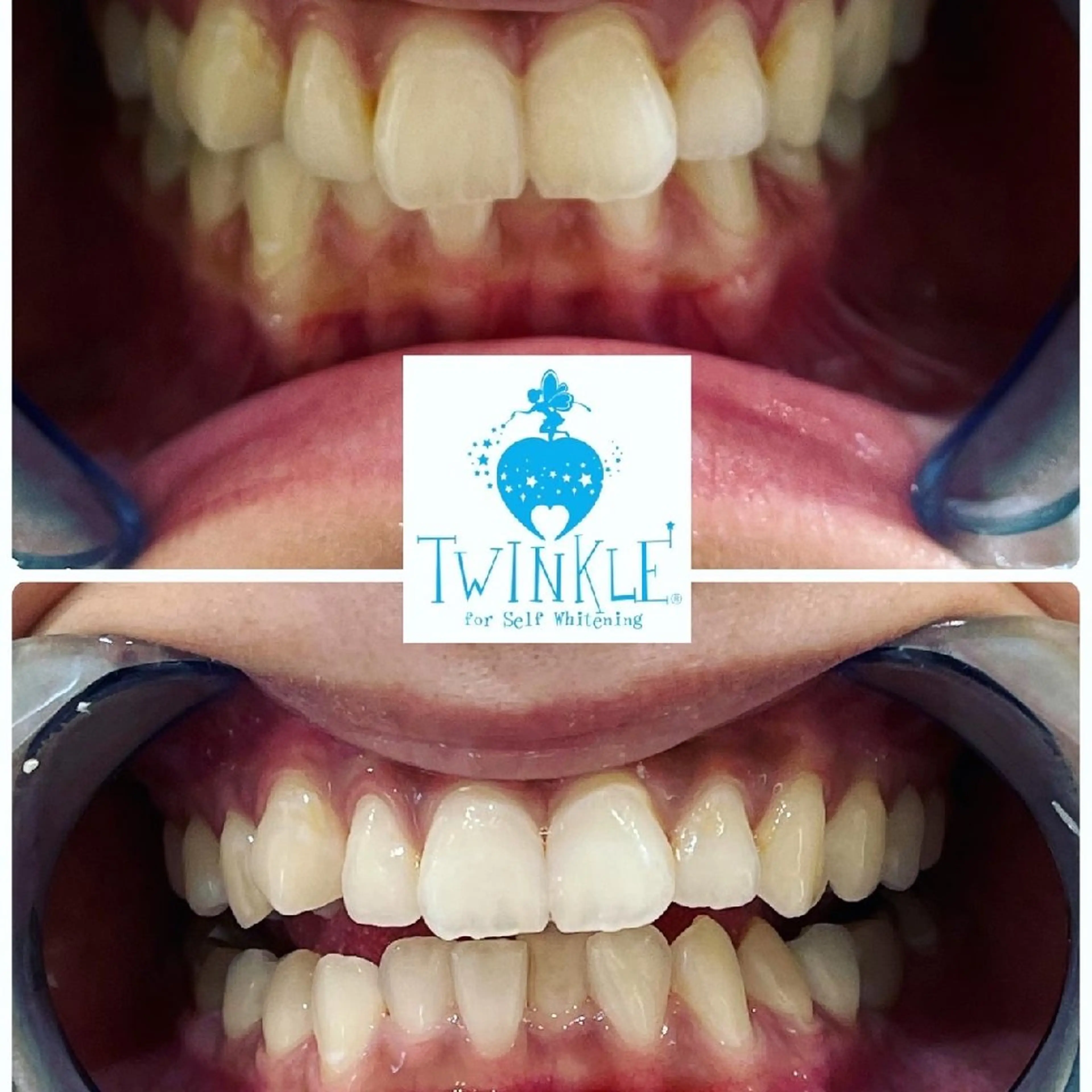 ✨当店人気Nｏ.2！セルフホワイトニング　スタンダードプラン　8分☓4回の写真