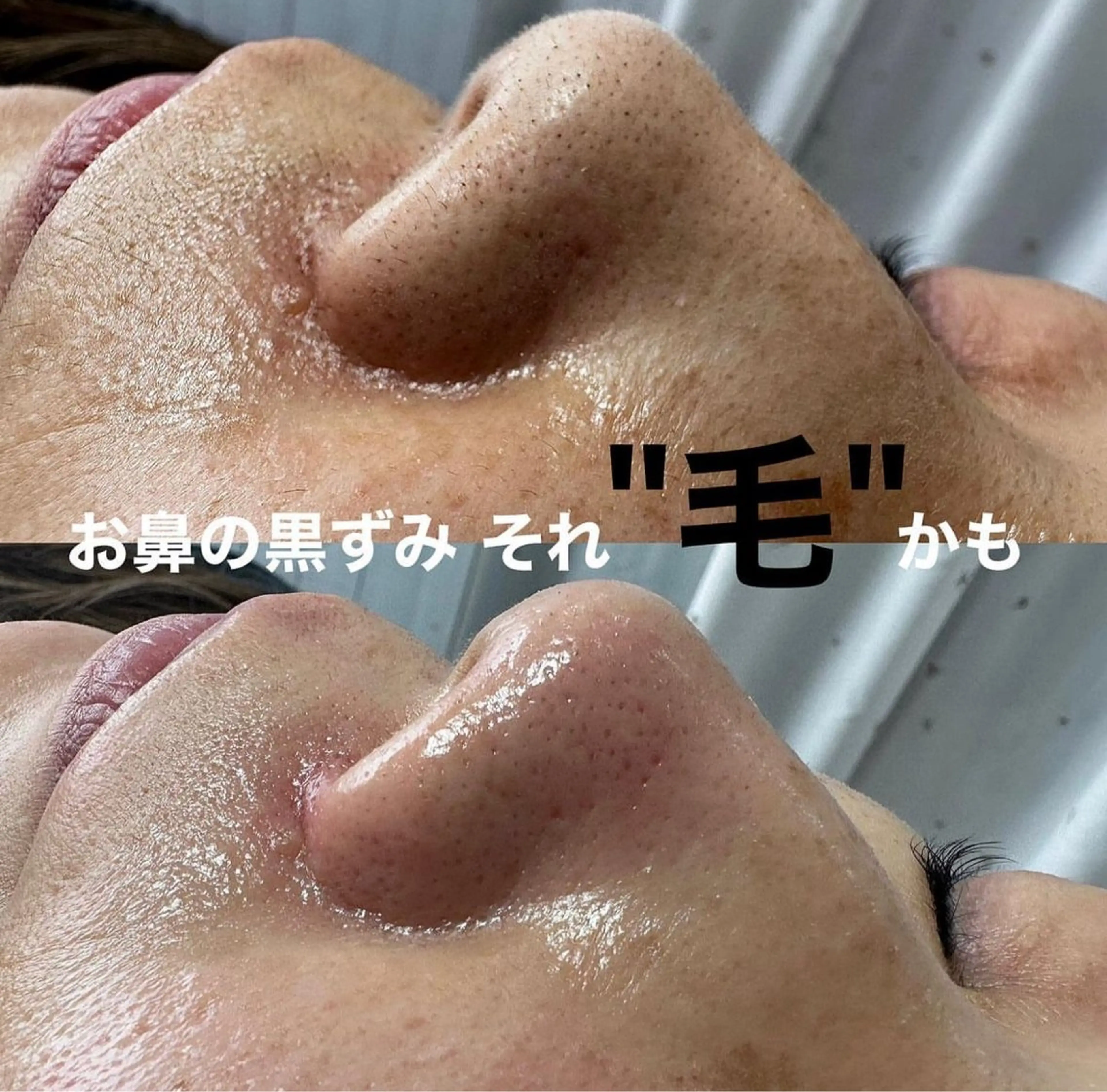 🪸ツヤ肌🫧フェイシャルワックス脱毛の写真