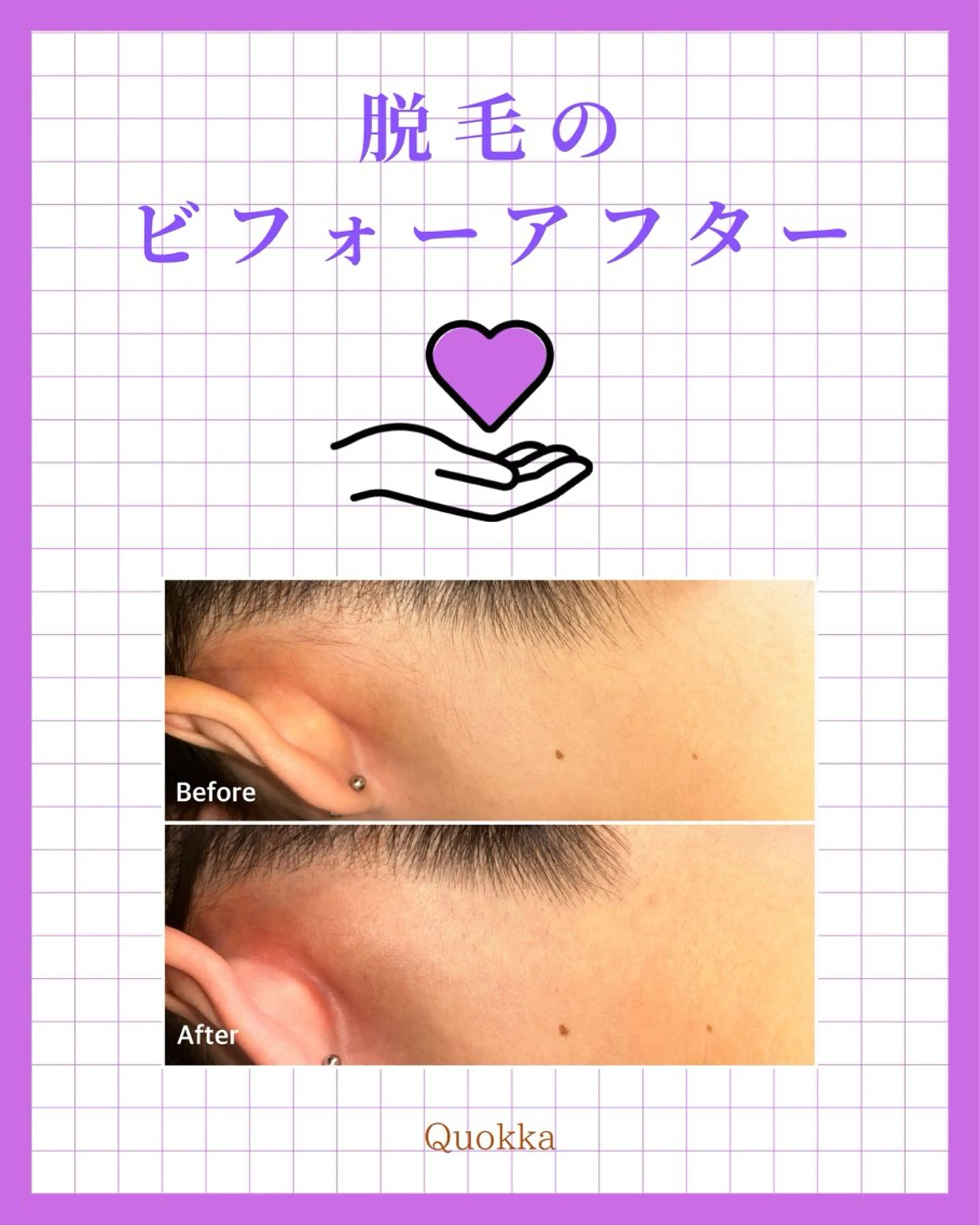 脱毛 Quokka ✴︎ あま市甚目寺のエステ・リラクイメージ