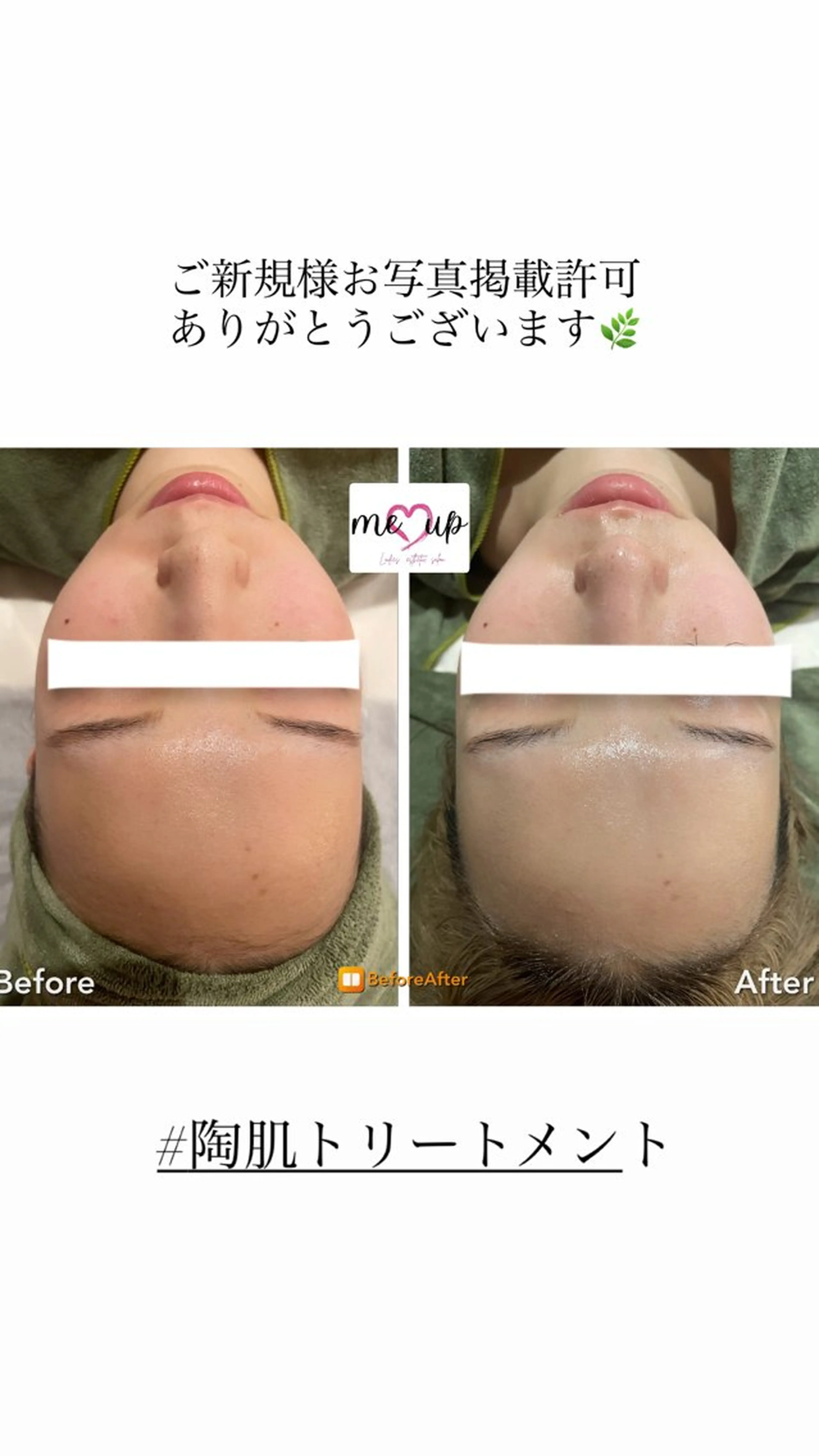 エステ Meupニキビ専門店 背中/ハーブ/肌管理のその他イメージ