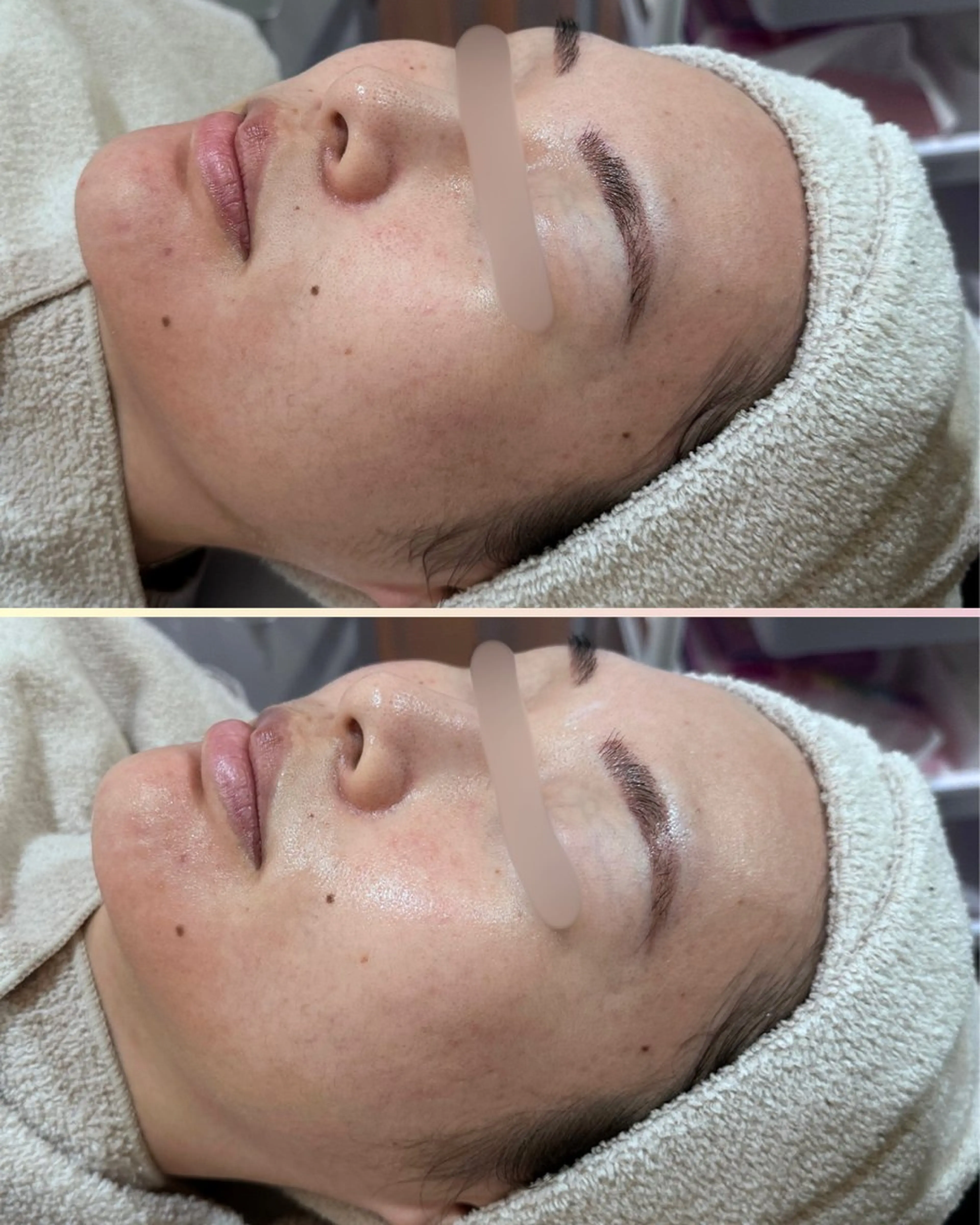 エステ |ピーリング・毛穴| soina神楽坂のエステ・リラクイメージ