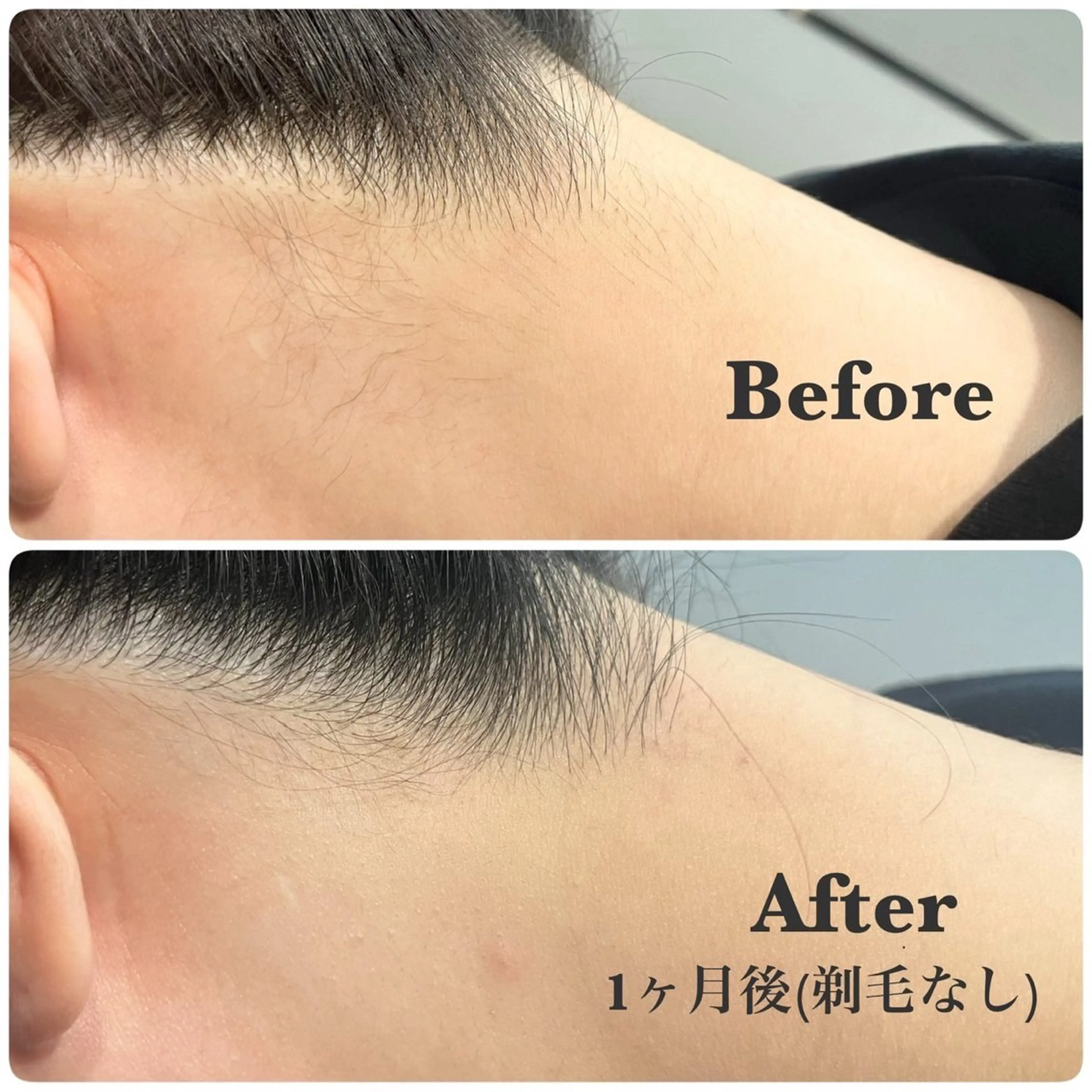 【初回限定】モニター価格💡うなじ・背中脱毛（シェービング込み）の写真