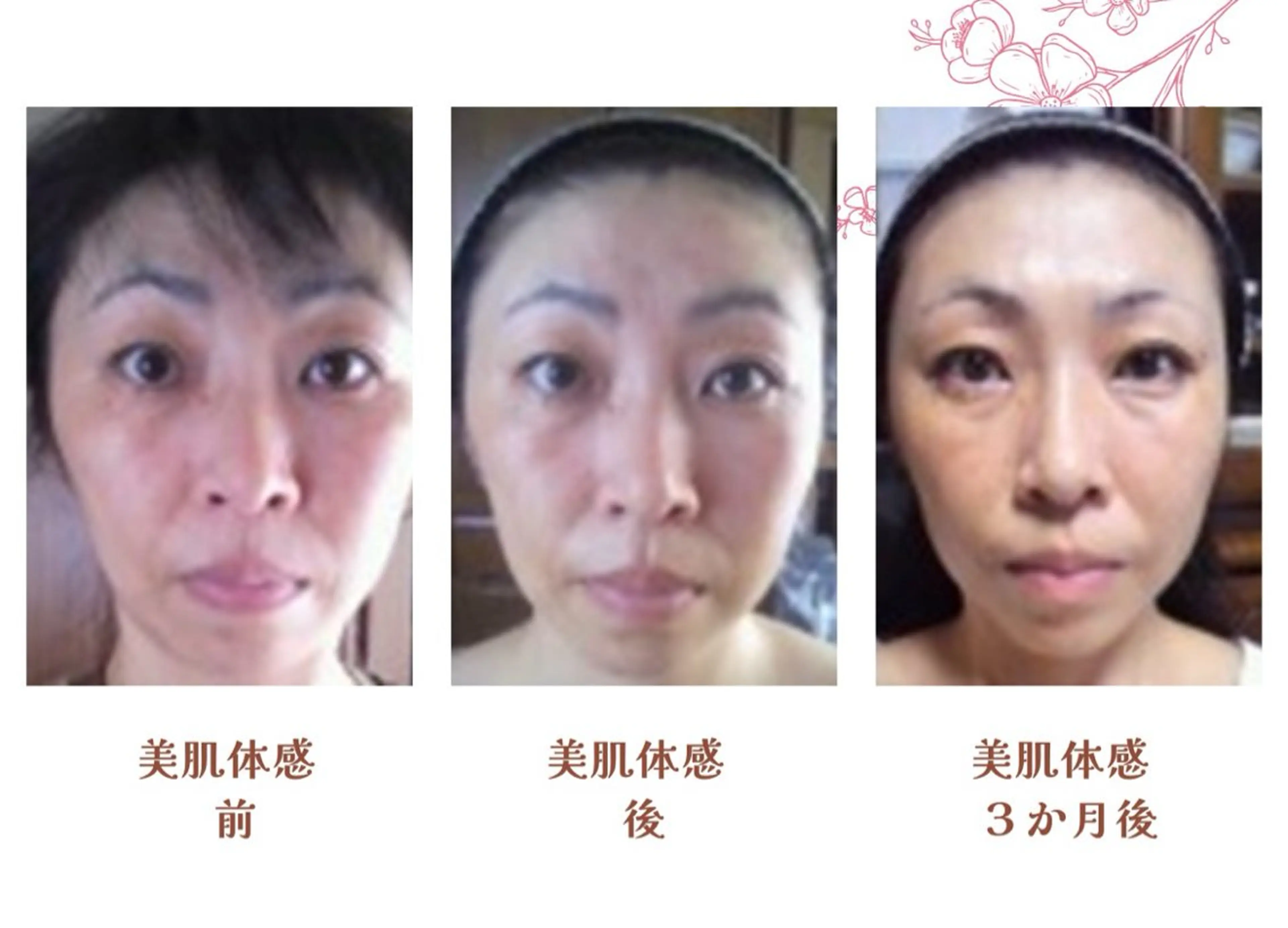 3,850円​〜​叶う、1ヶ月集中美肌プログラムの写真