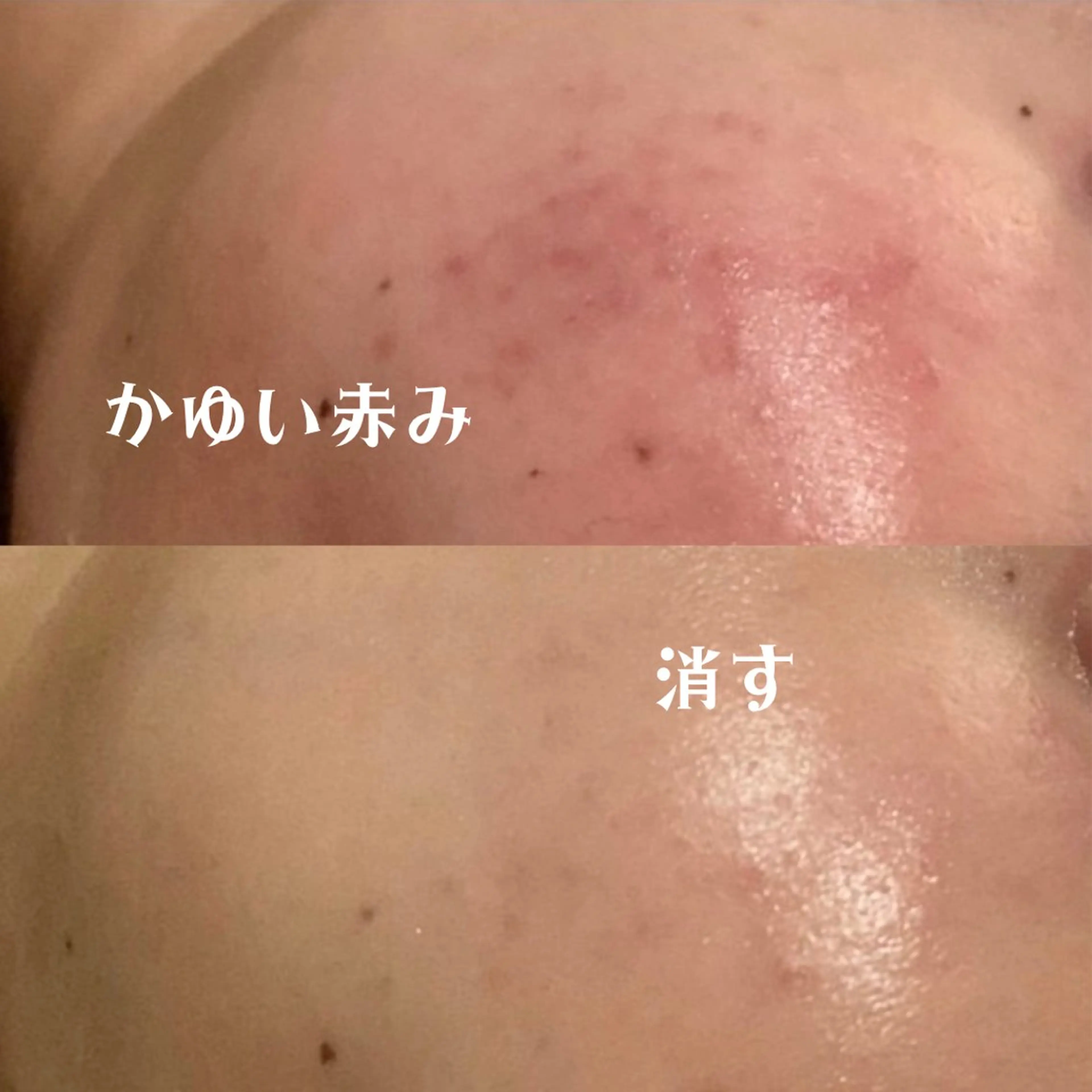 【13日限定❤️❕】ニキビ/ニキビ跡/毛穴/乾燥などが気になる方⭐️3300円‼️の写真