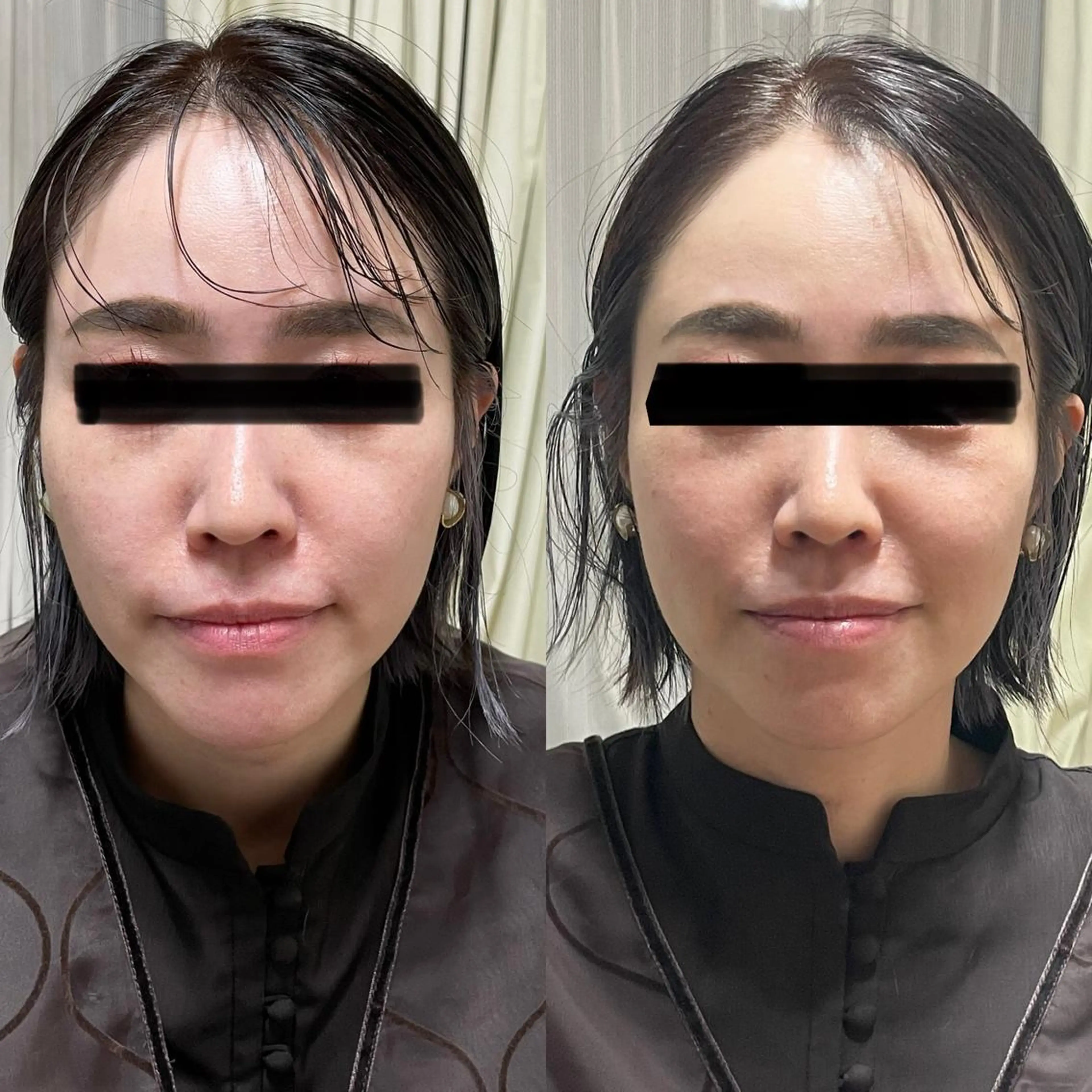 その他 つばさ所属・マッツンの 鍼のその他イメージ