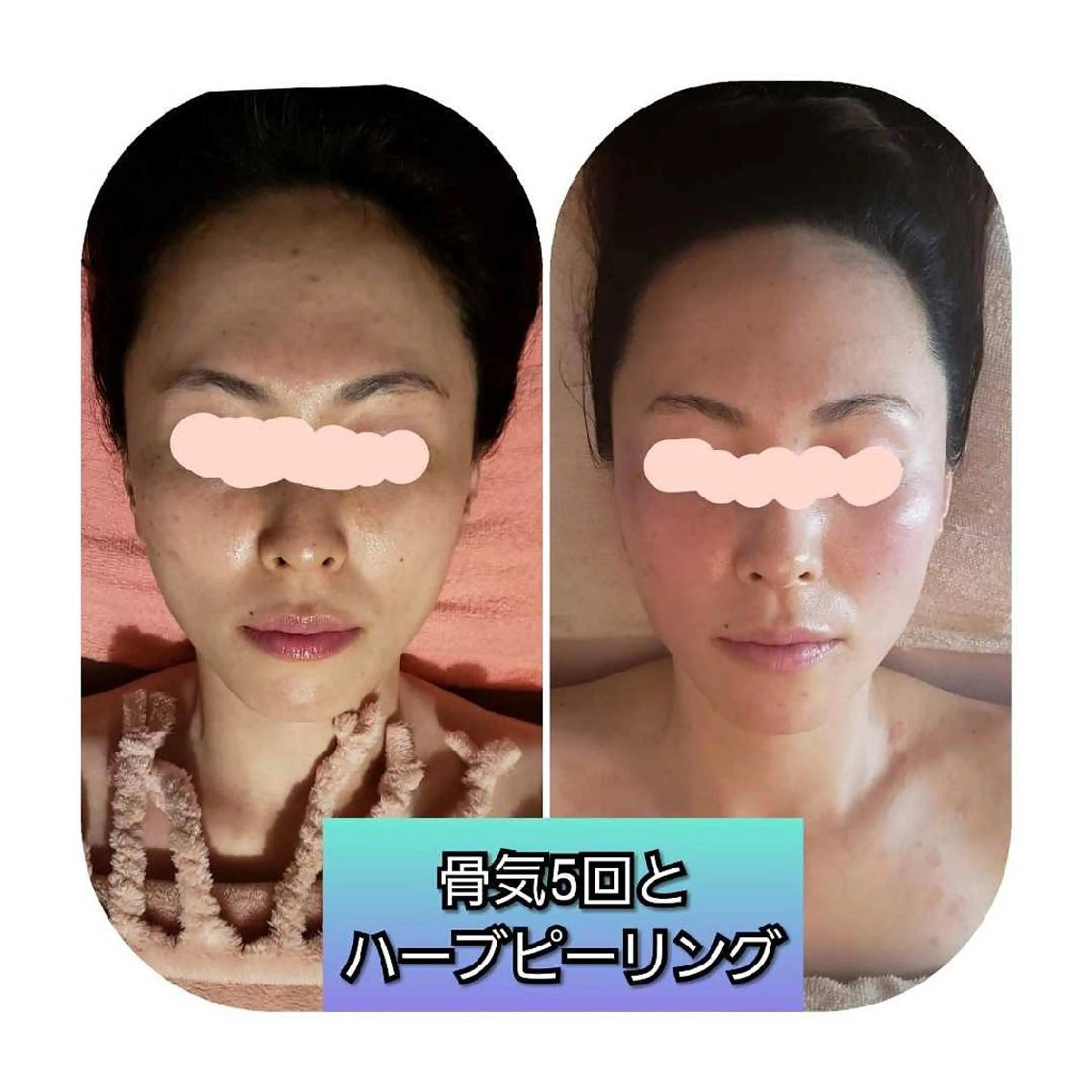 毛穴ケア くすみ肌 ハーブピーリングのエステ・リラクイメージ