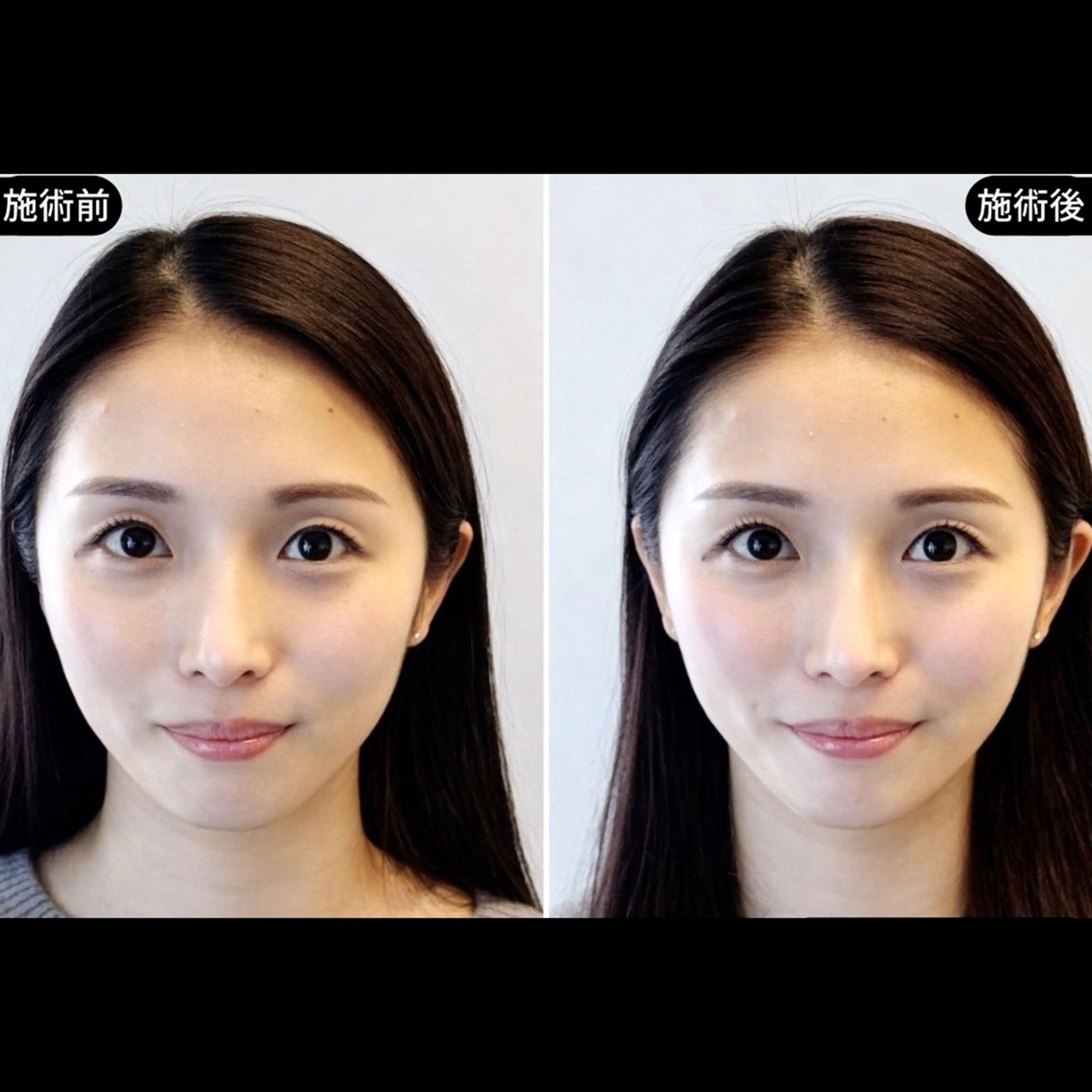 【ブライダル・撮影前 顔と体を整える】美容整体×EMS美容鍼 90分の写真