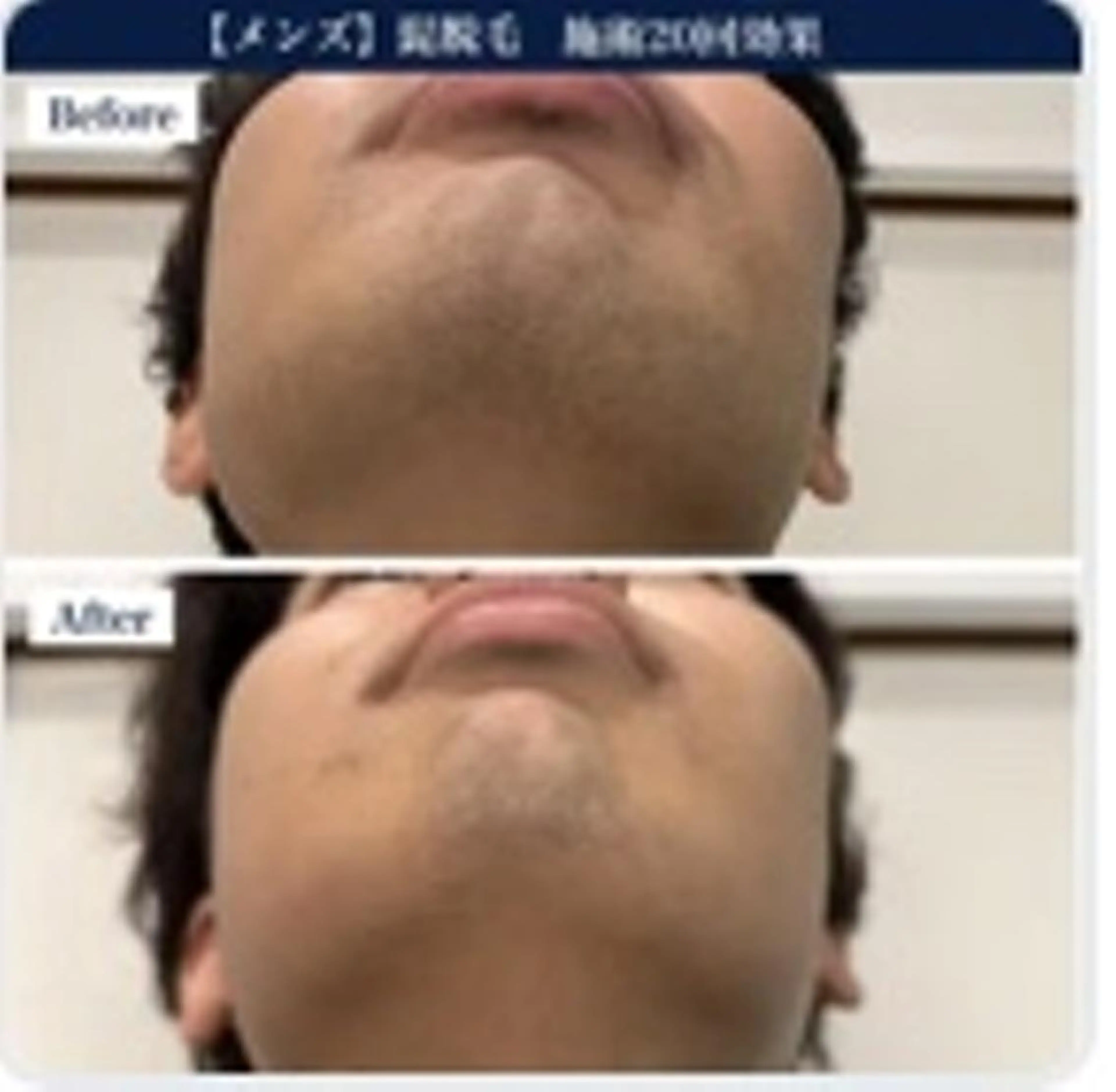 ＃枚方市メンズひげ脱毛　【メンズ限定】ヒゲ脱毛の写真