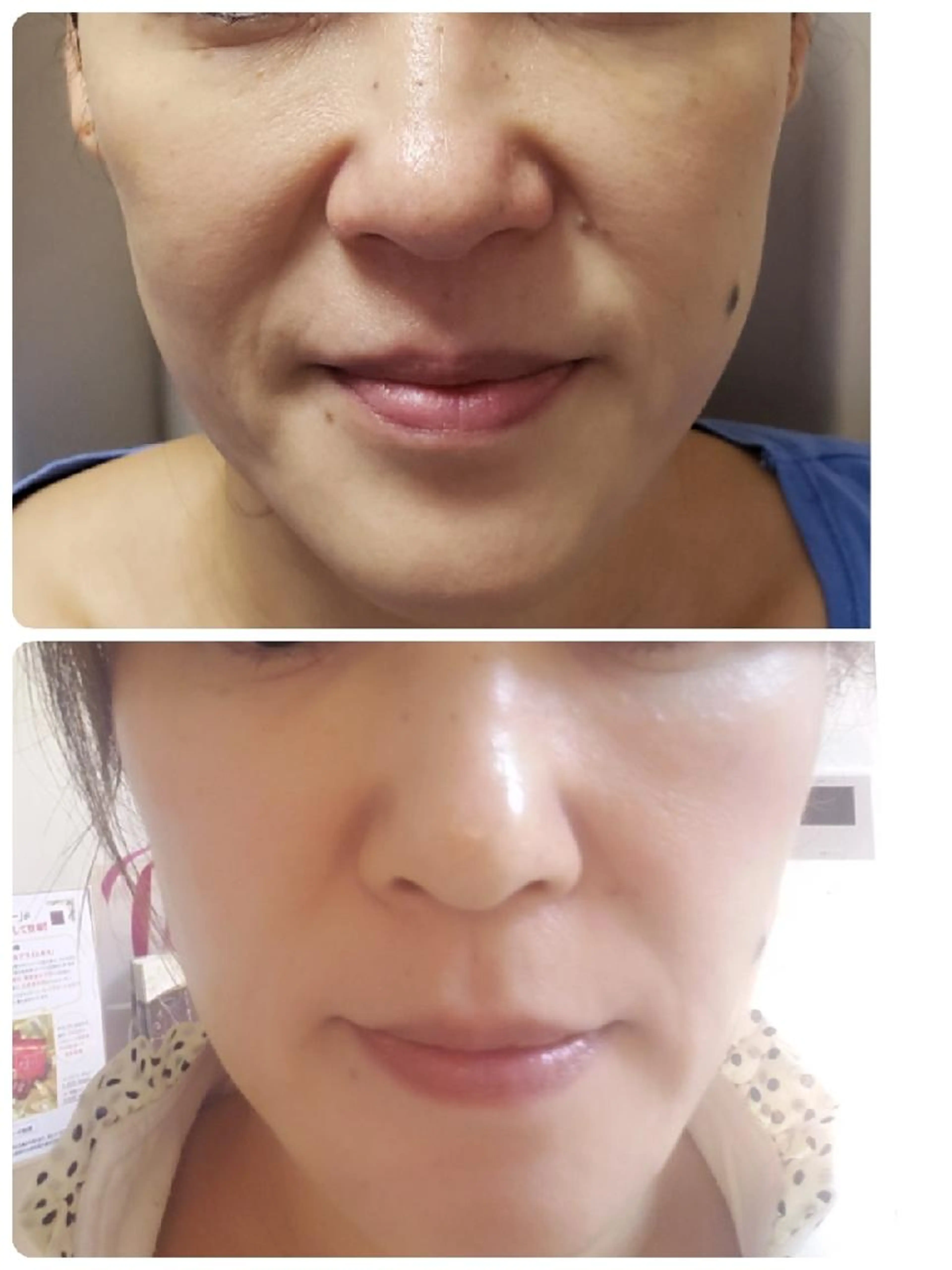 【最新スリムショック頬リフト】ほうれい線解消、頬引き締め￥9,800の写真