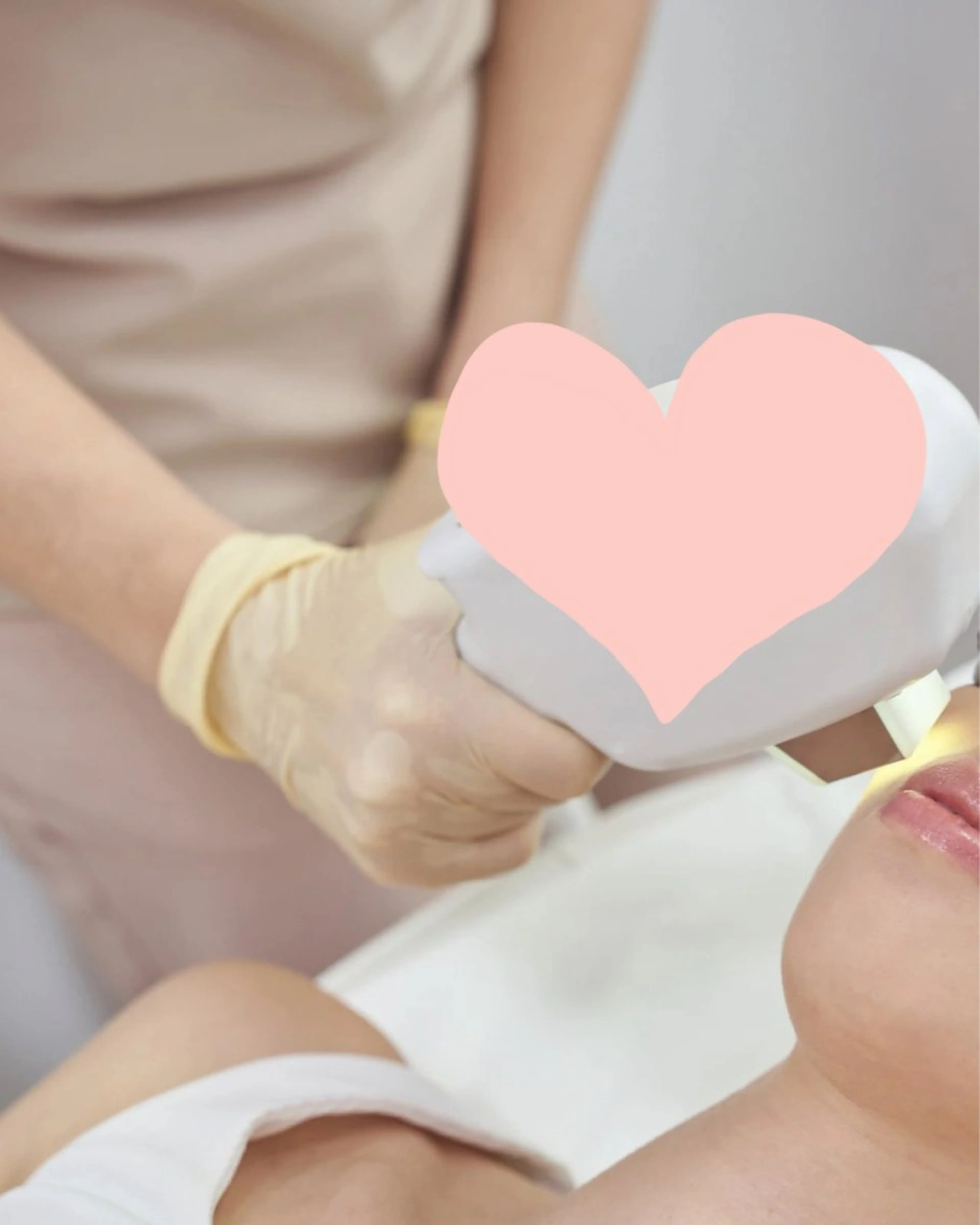 ✨【上唇の脱毛】美肌に導くワンショット脱毛 ✨の写真