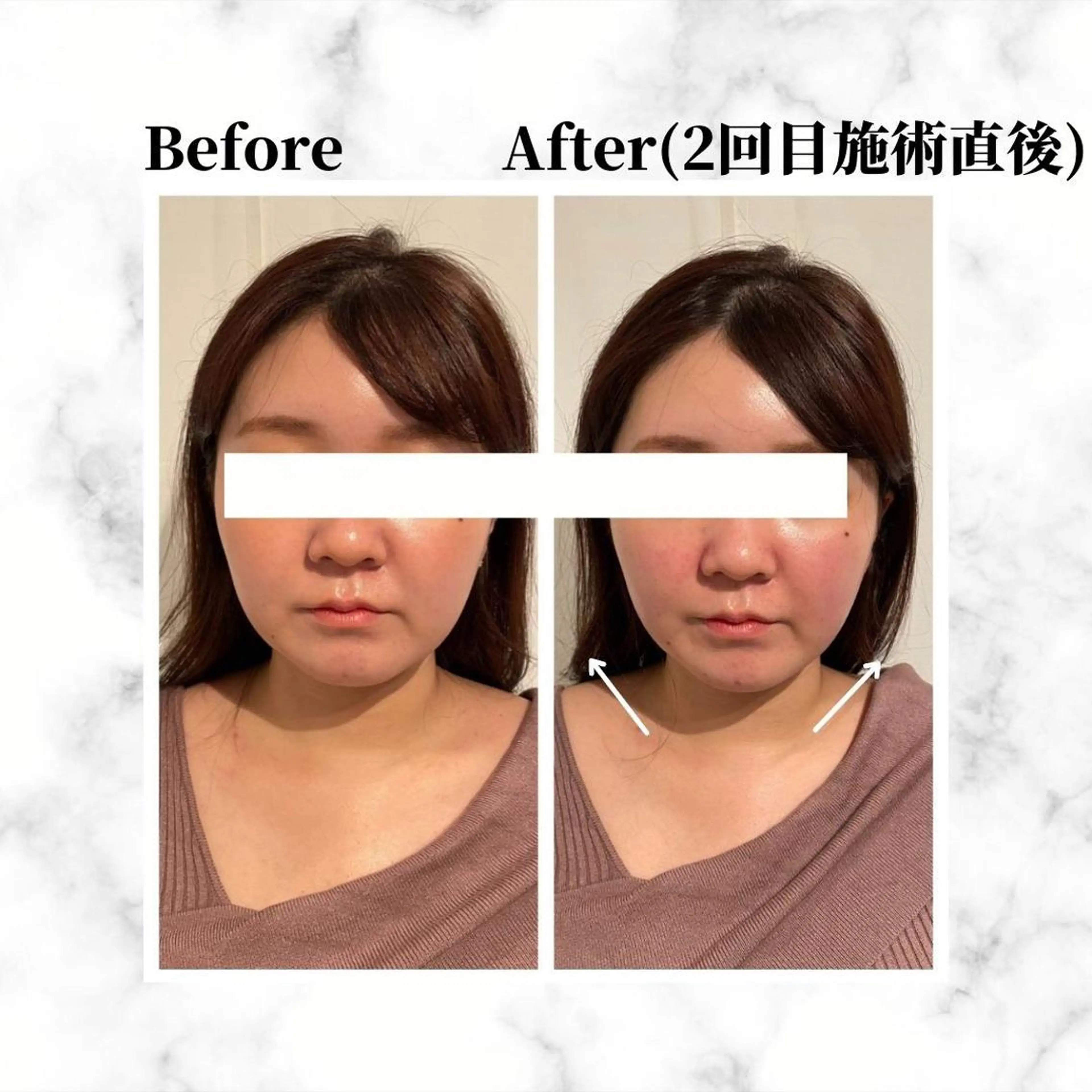 エステ リラク 12Dハイフ💗 最強小顔のエステ・リラクイメージ