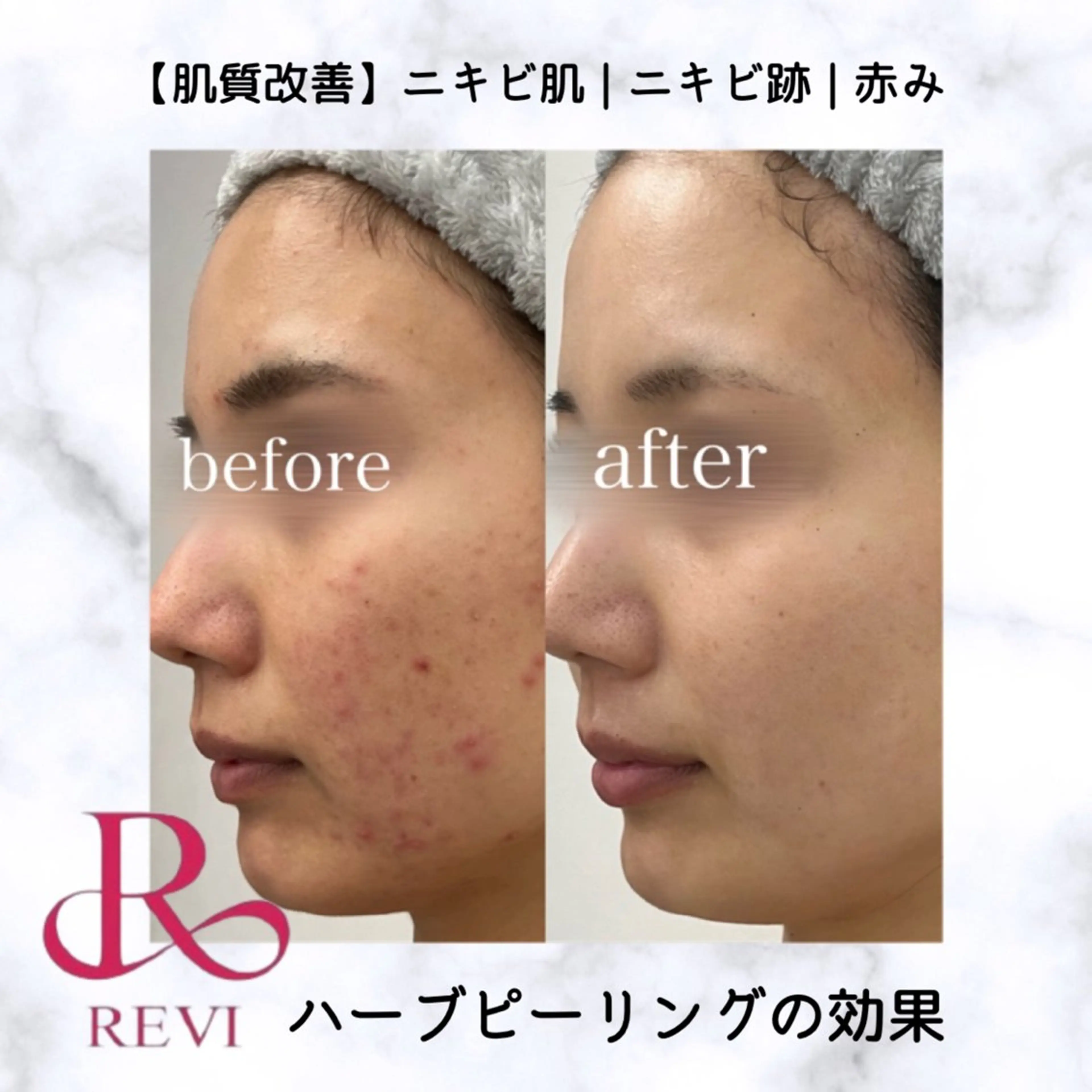 エステ REVIハーブピーリング/バストケア/脱毛 Retea.【ルテア】所属・ハーブピーリング| 毛穴洗浄|ルテアのエステ・リラクイメージ