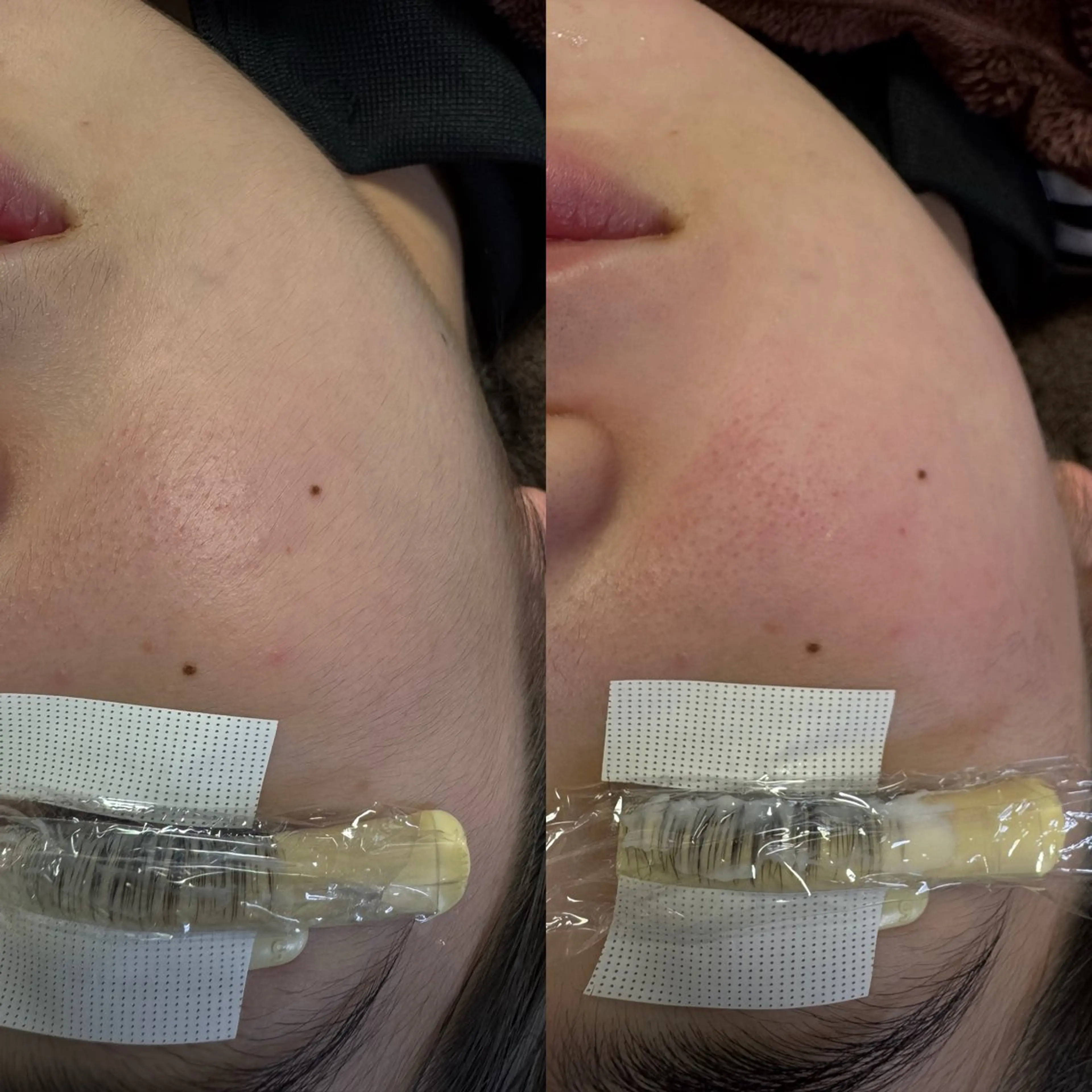 ⭐︎人気No.1⭐︎《眉毛＆まつ毛＆お顔脱毛》　　　　　　　　　　　　　スペシャルセットの写真