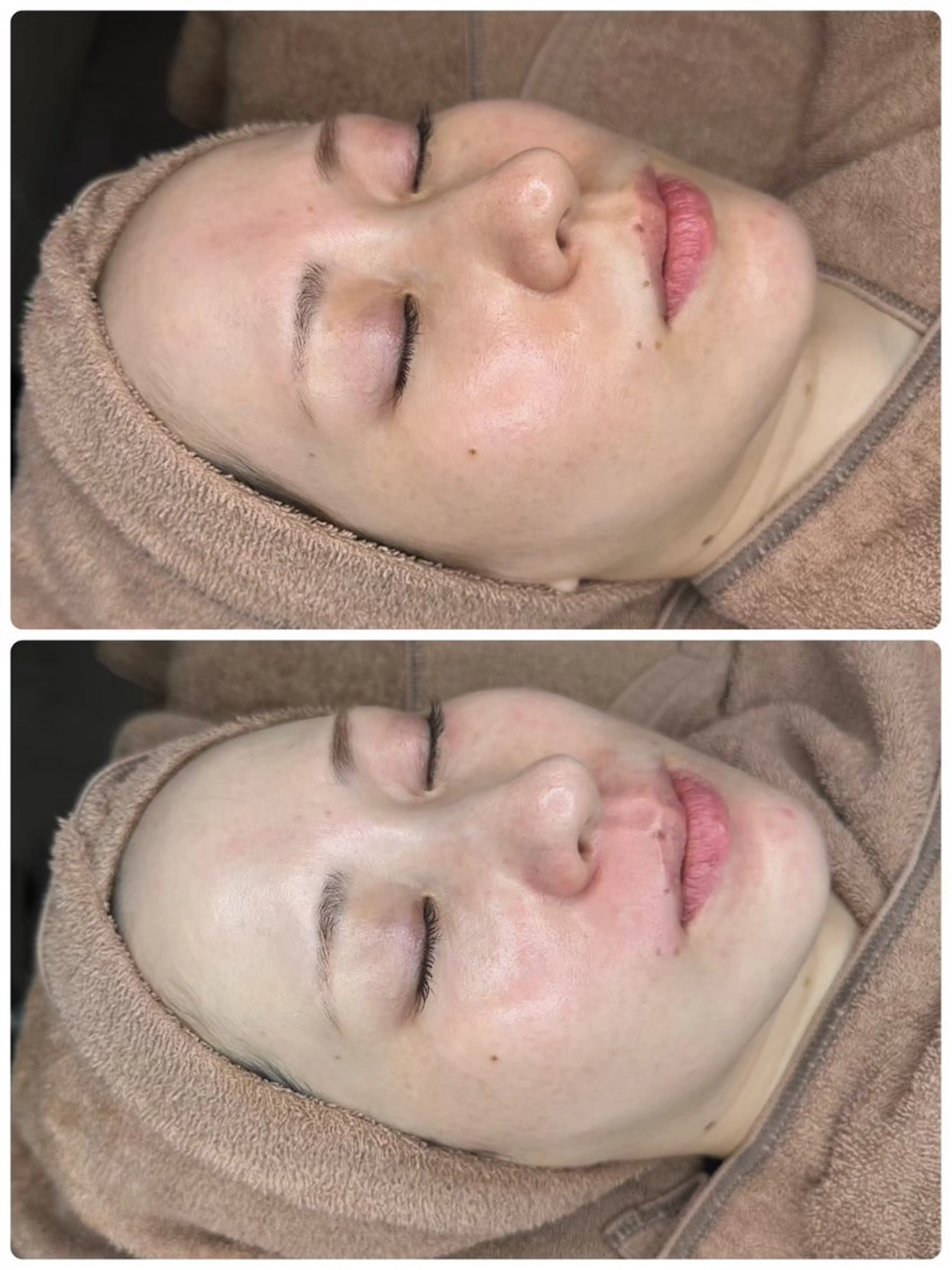 【水光ツヤ肌】ララピール肌質改善ケアの写真