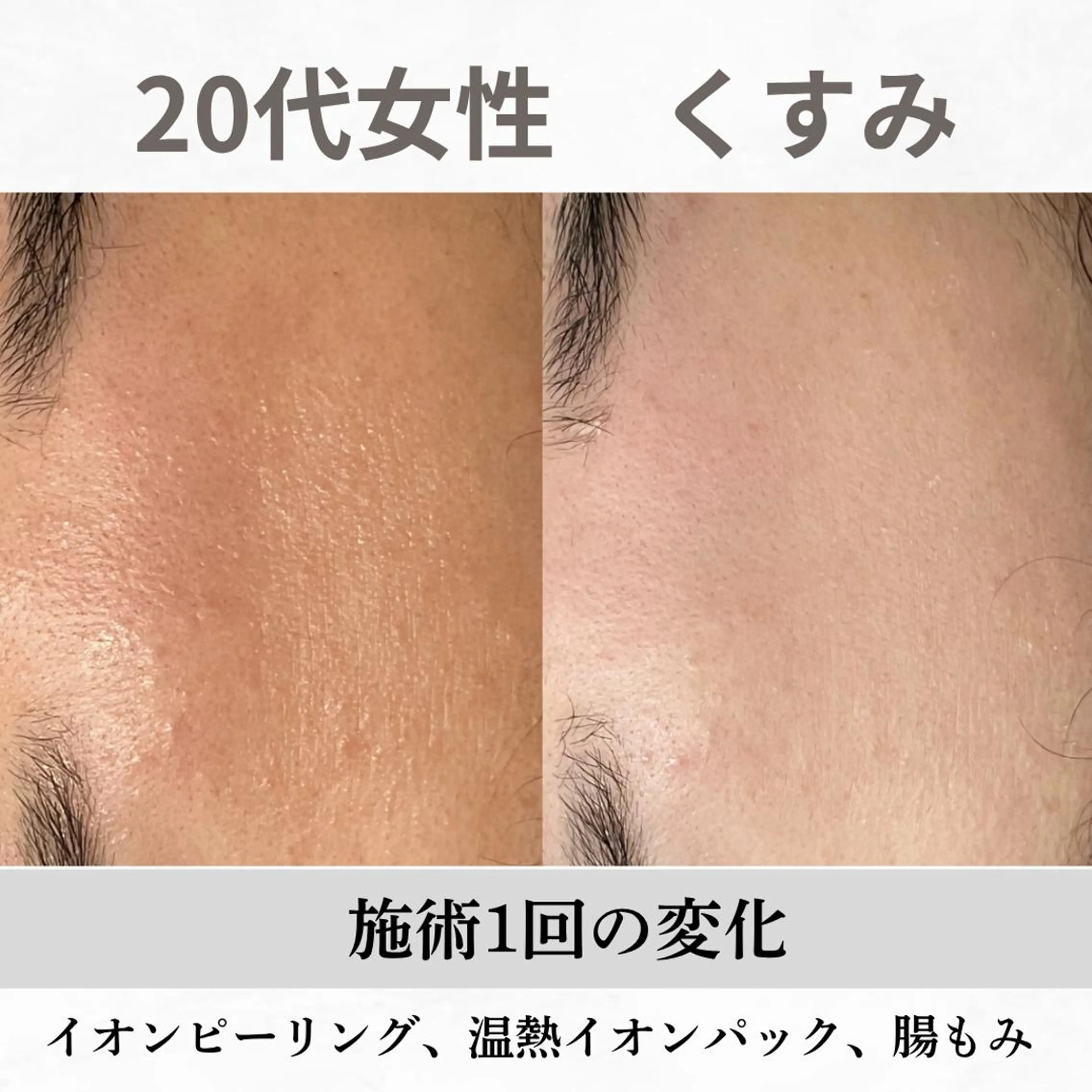 重度ニキビ専門🌷 ダウンタイムなしのエステ・リラクイメージ