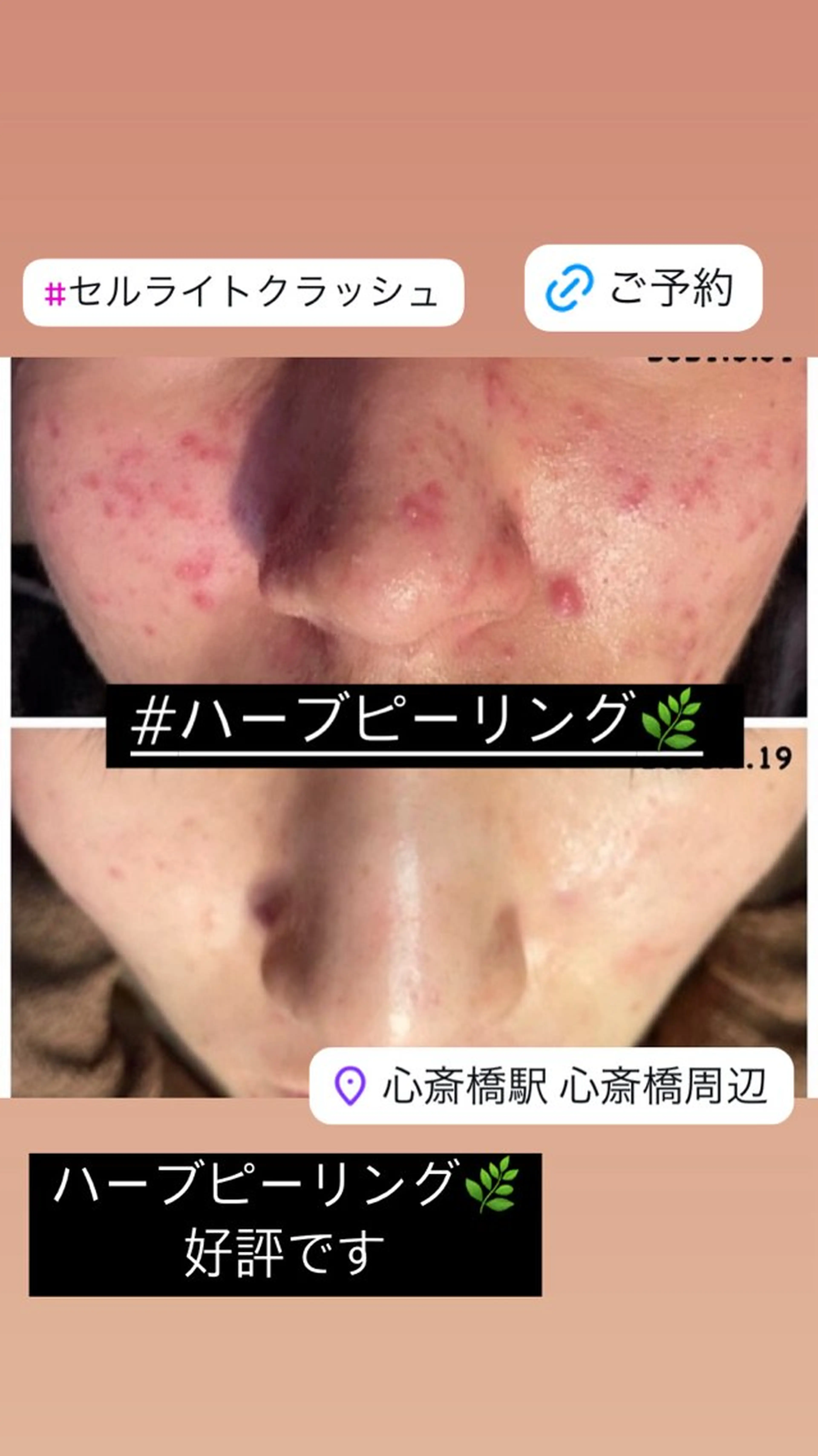 🌿国産ハーブピーリング🌿　1部位選んで！！の写真