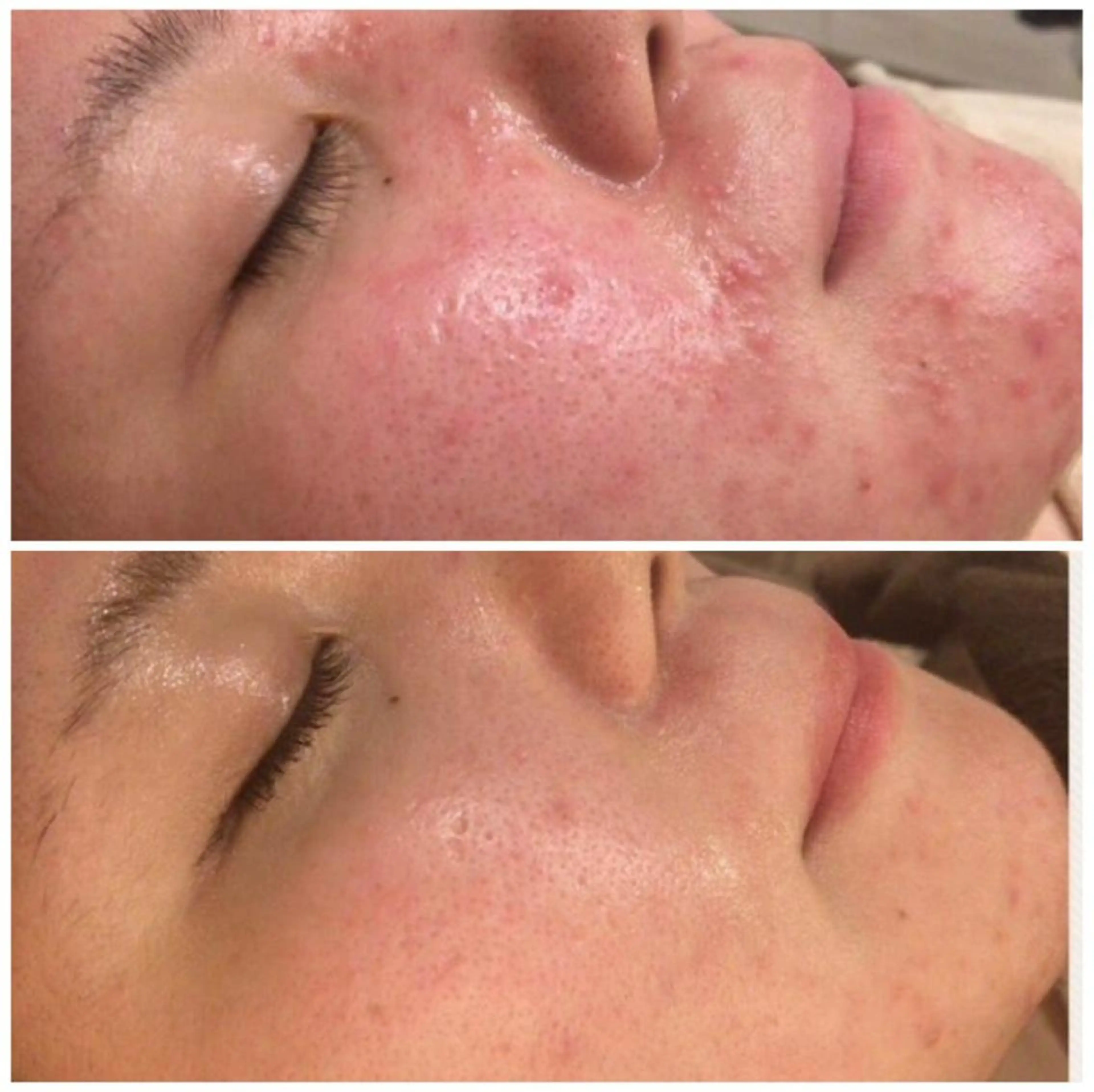 都内で出来る肌管理！ 最短ニキビ改善のエステ・リラクイメージ