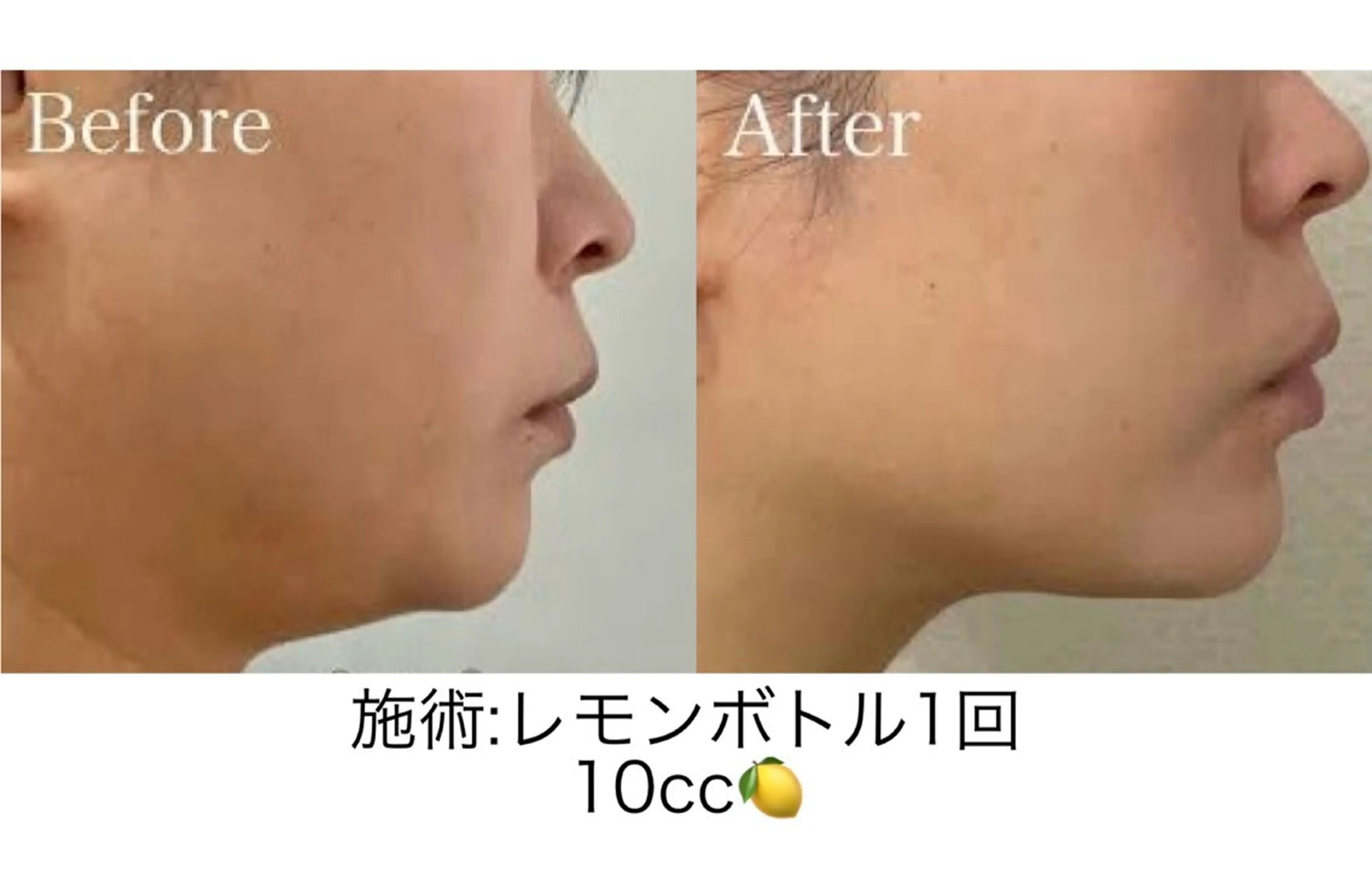 予約殺到✨話題のレモン/ボトルお時間無い入れ放題🍋最大6cc❗️》💆‍♀️の写真