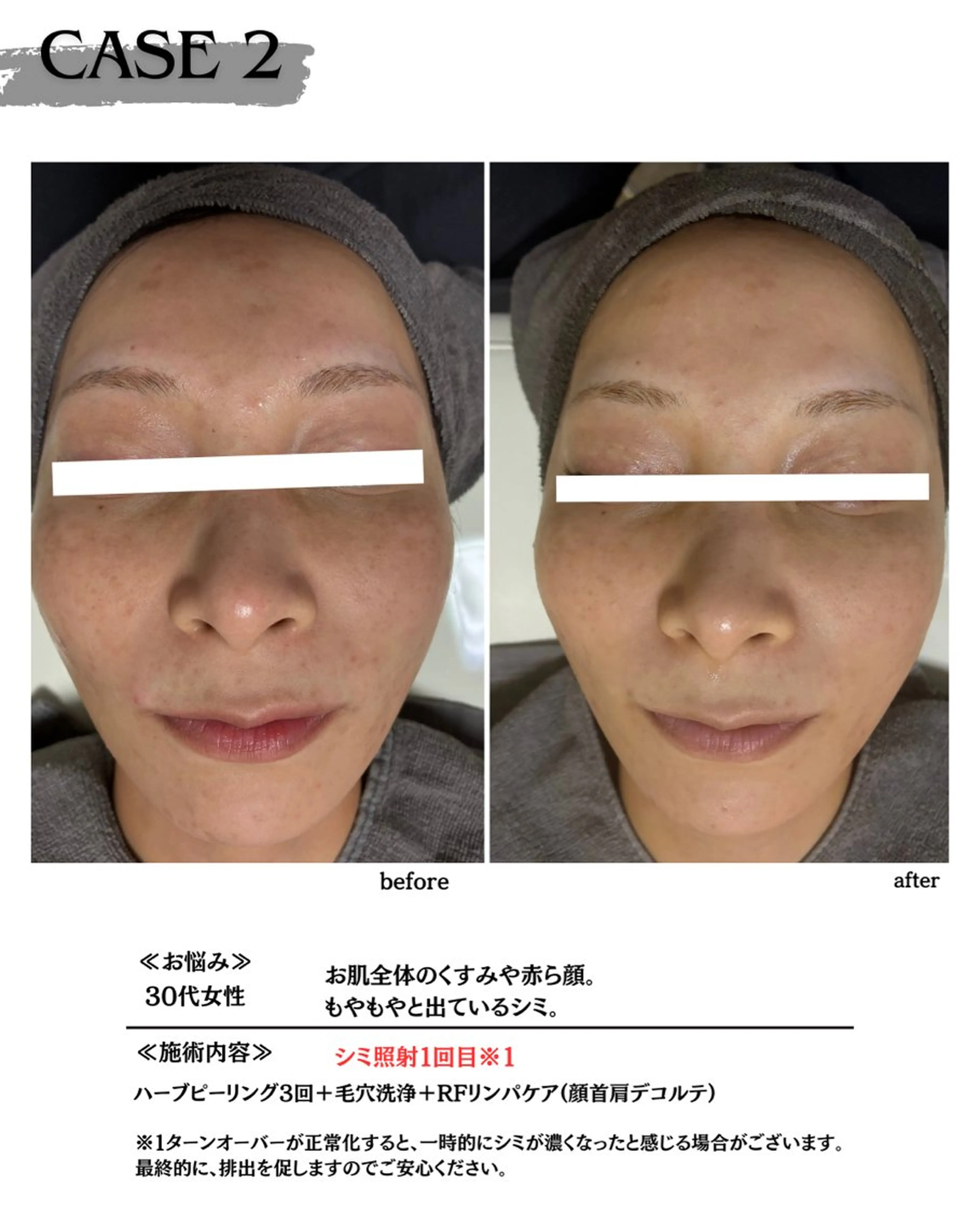 エステ 素肌育成・シミケア専門サロン美潤-miulu-所属・【医療提携サロン】 【シミケア専門】のエステ・リラクイメージ