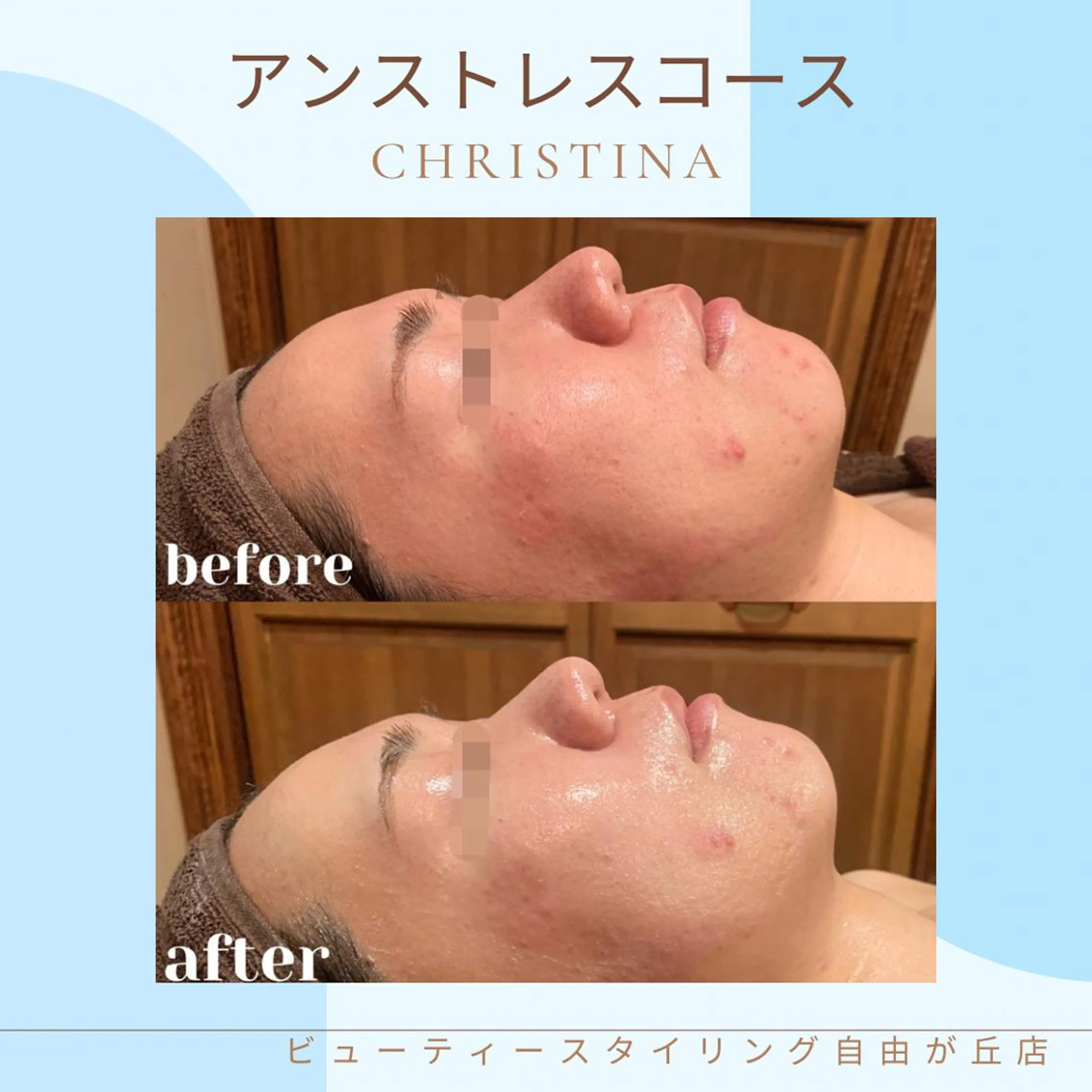 肌のストレス悩みに🛁【かゆみ・炎症・赤み・乾燥】当てはまったらこちらのコース✨の写真