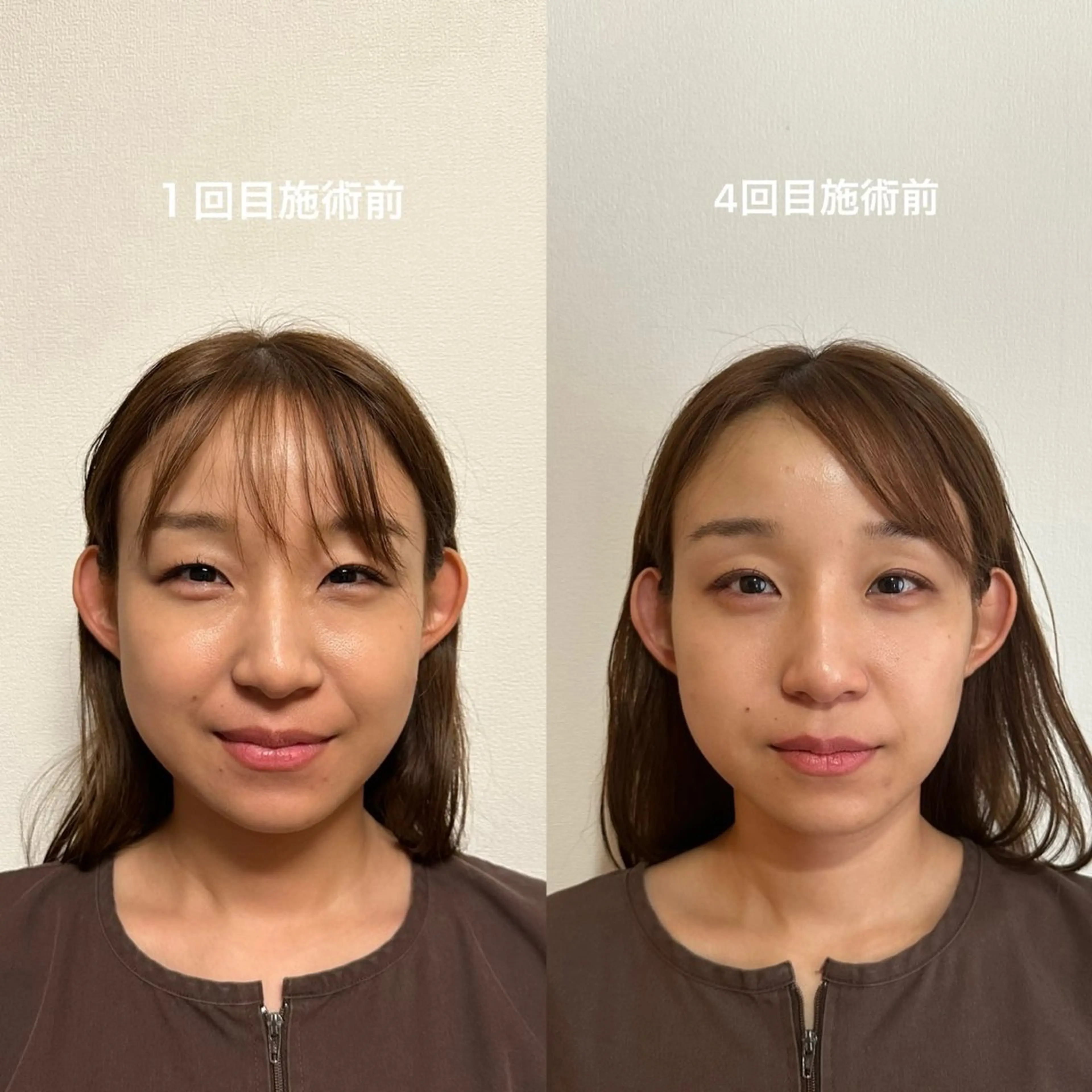 エステ 即小顔♥️美容鍼× ハーブピーリングのその他イメージ