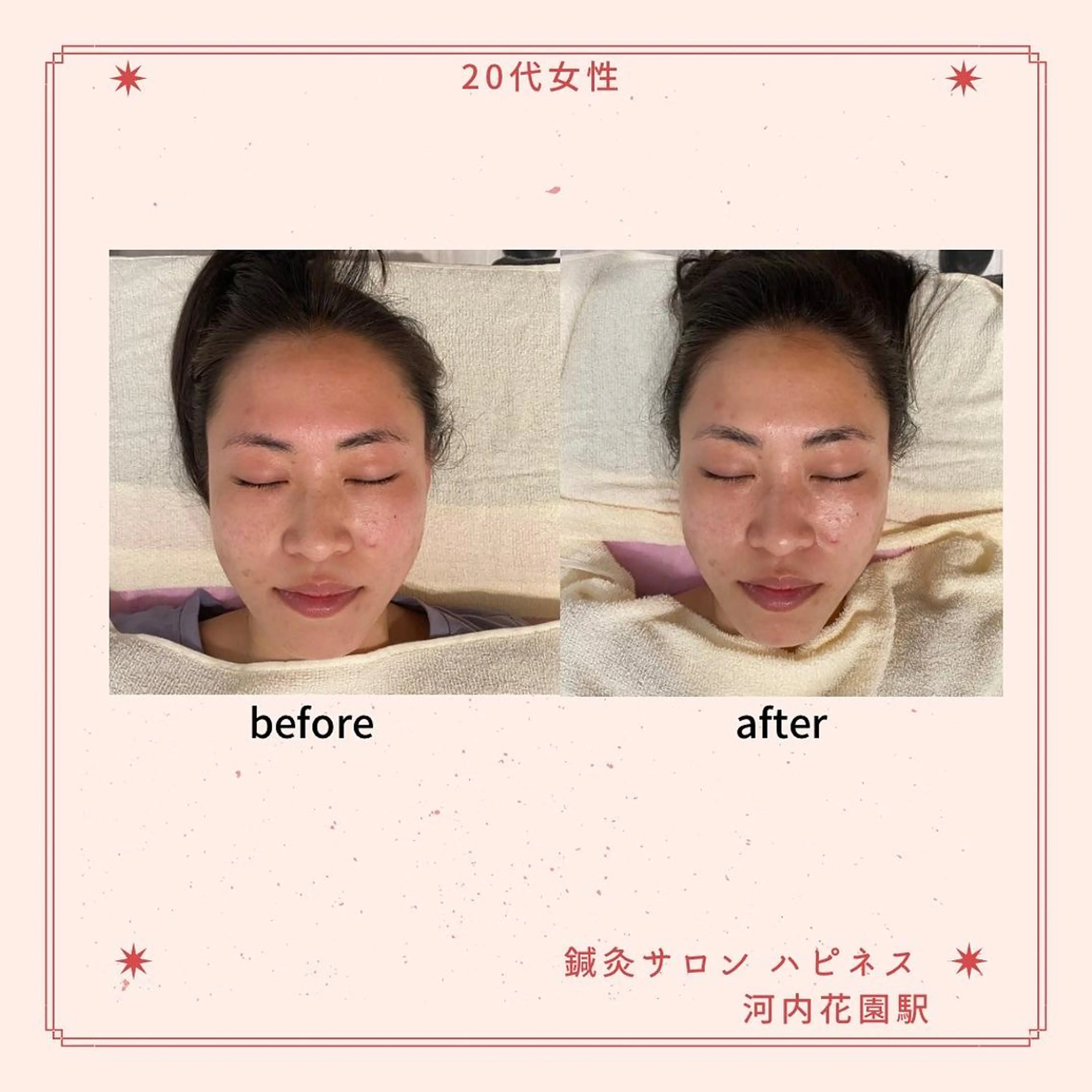 美容鍼サロン ハピネス所属・土手 真矢のその他イメージ