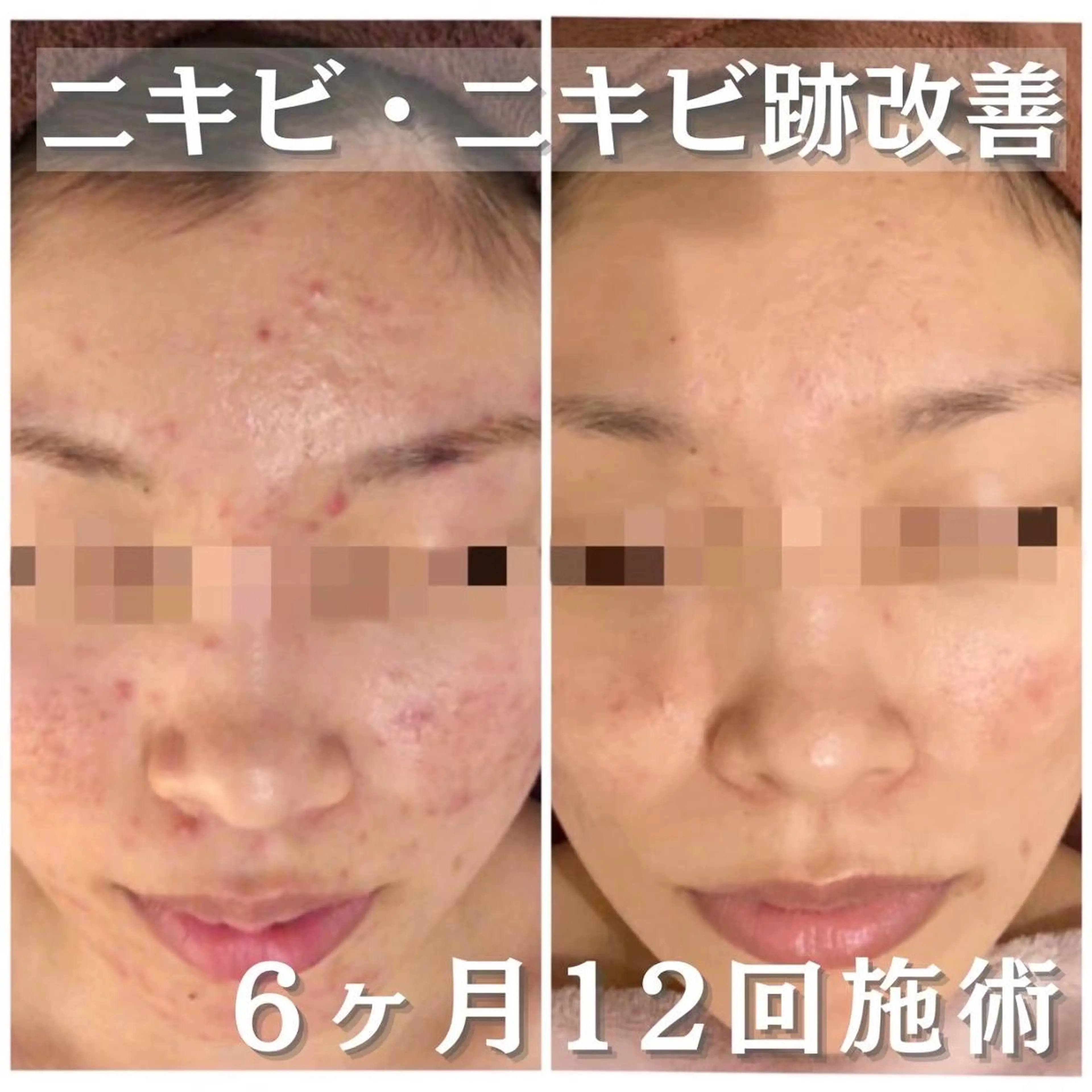 マツエク・マツパ エステ リラク 6万人の美肌実績🔥 最短ニキビ改善のエステ・リラクイメージ