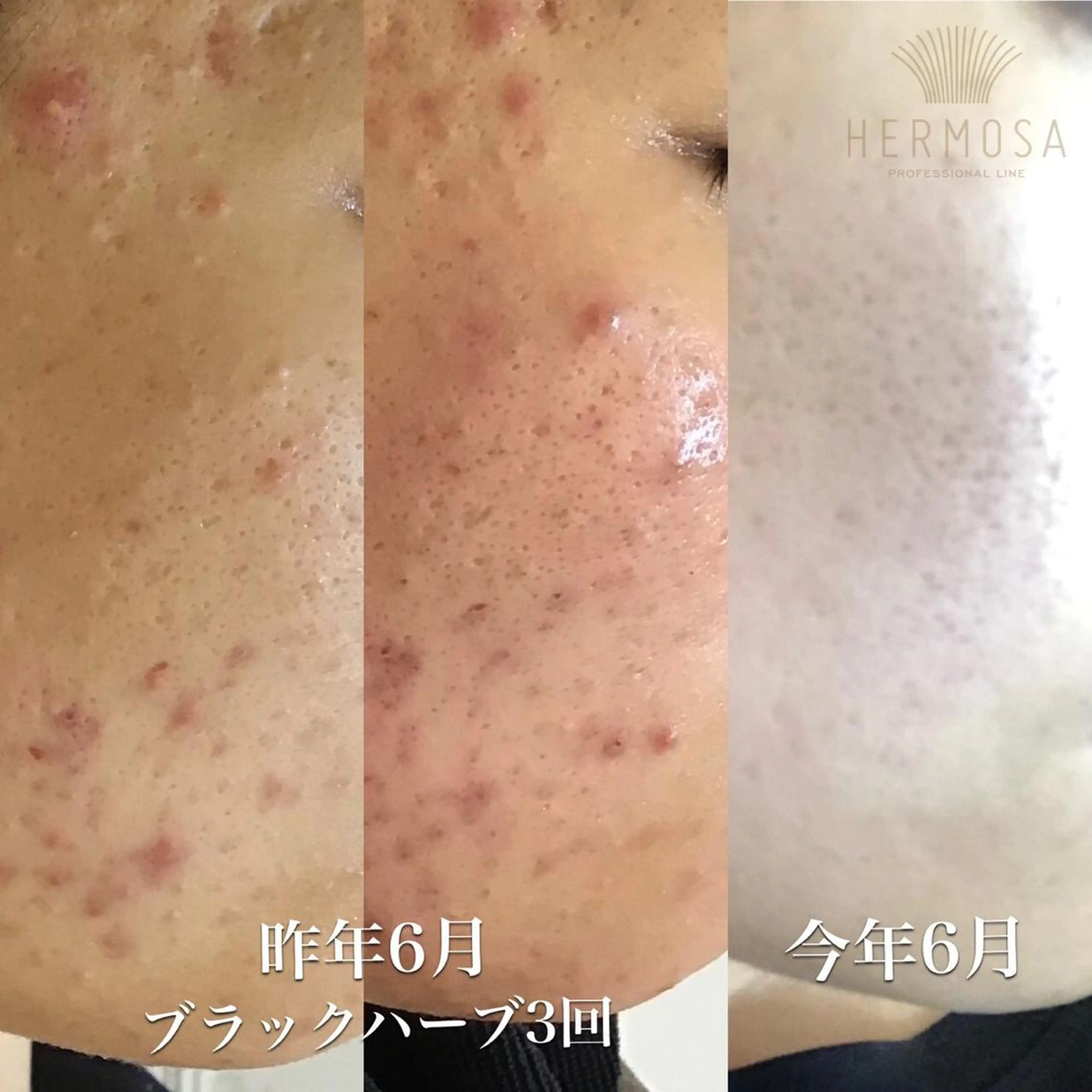 【ニキビ/肌管理】 salon varyのエステ・リラクイメージ