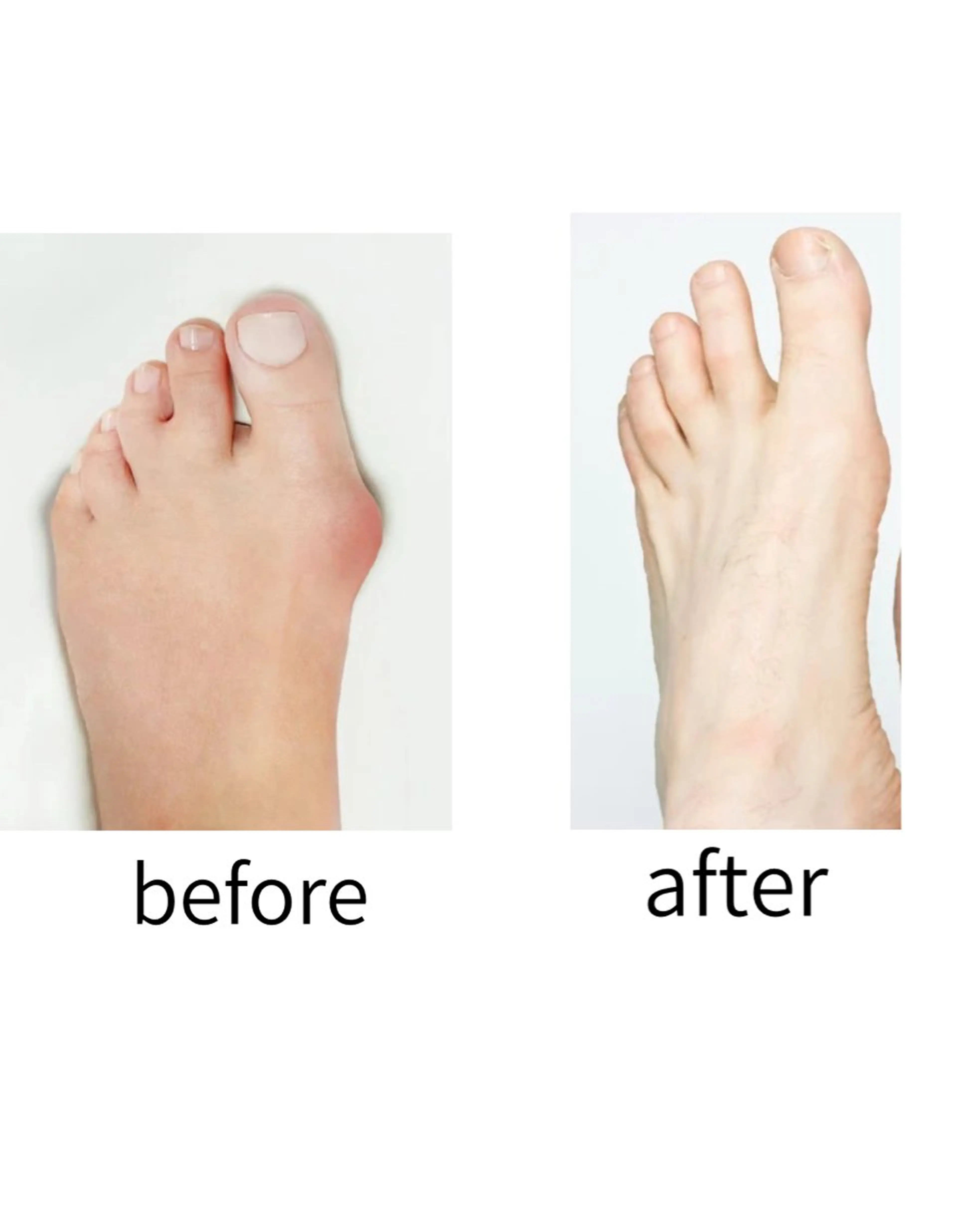 外反母趾特化型整体の写真