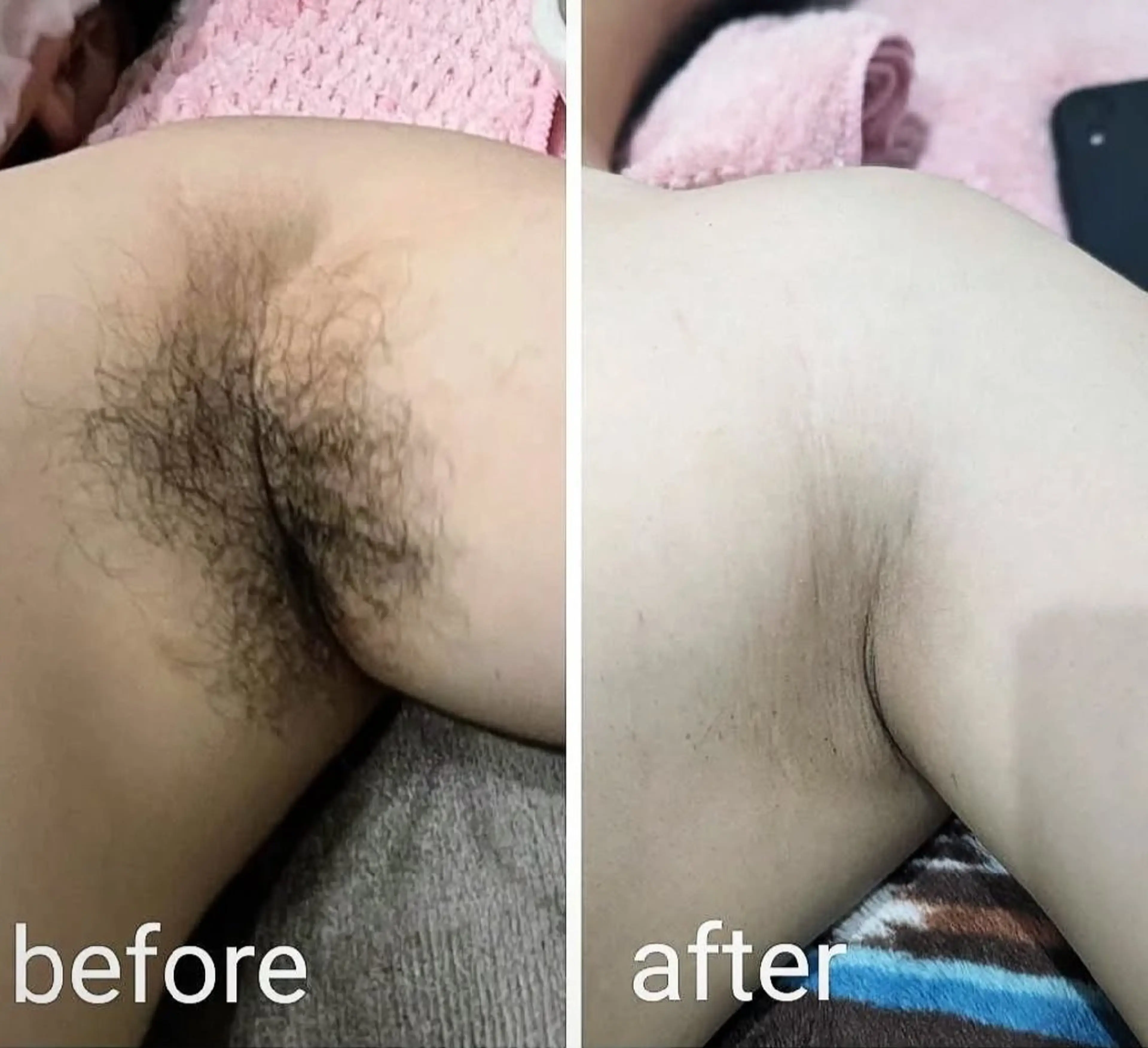 爆抜け脇脱毛✨の写真