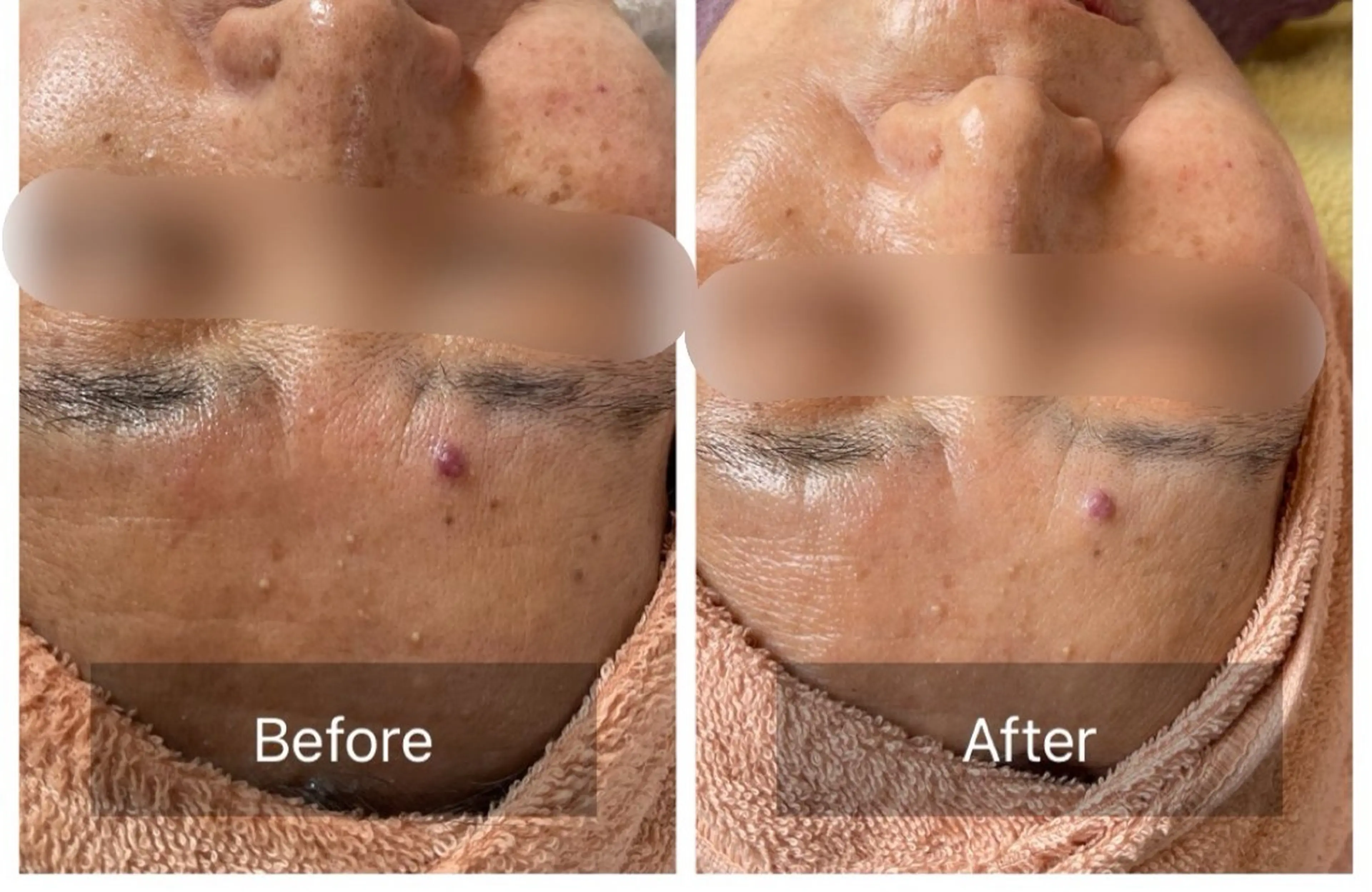 ハーブピーリング Lanaのエステ・リラクイメージ