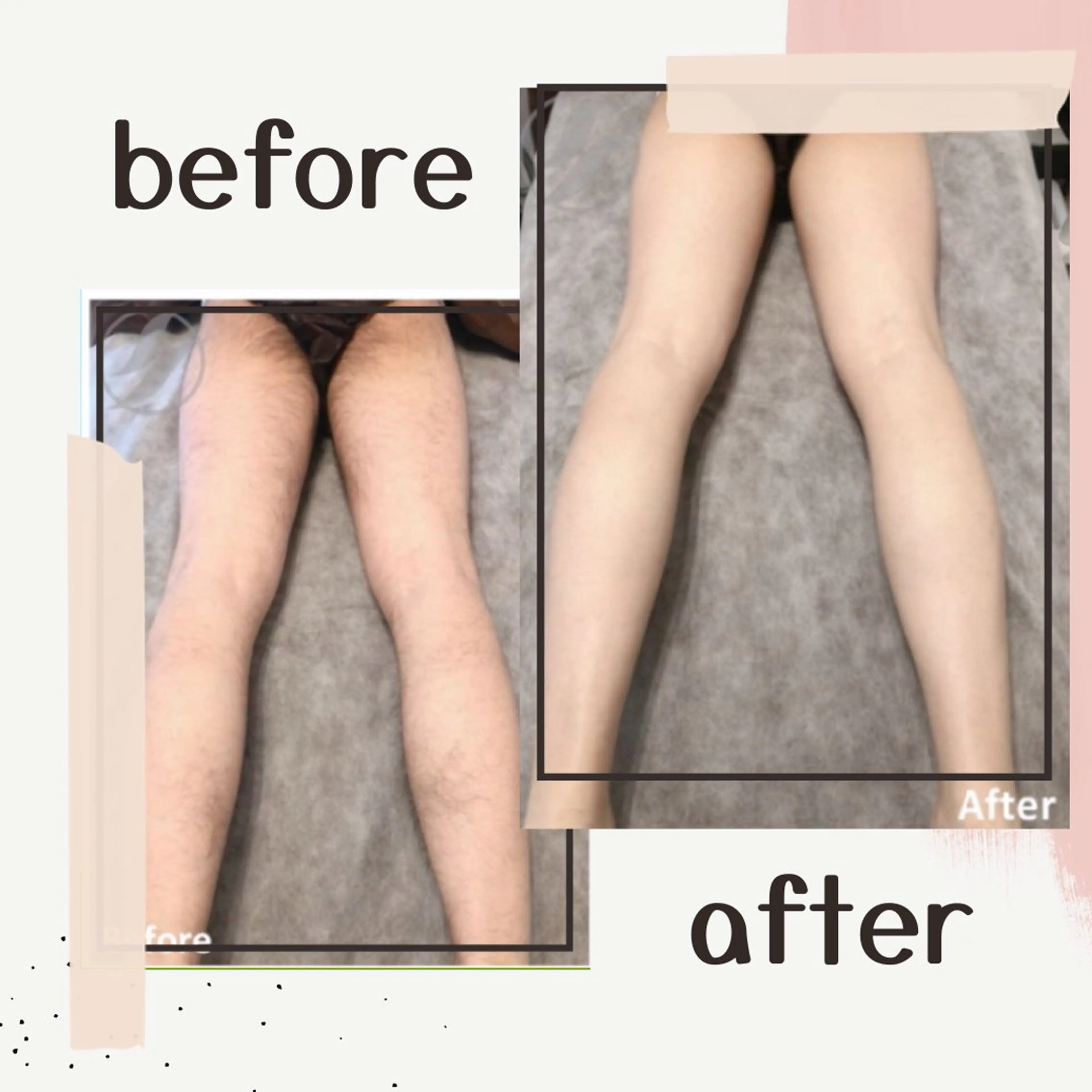 メンズ【両足脱毛】ムレ解消!清潔感UP♪★2回目まで同価格★の写真