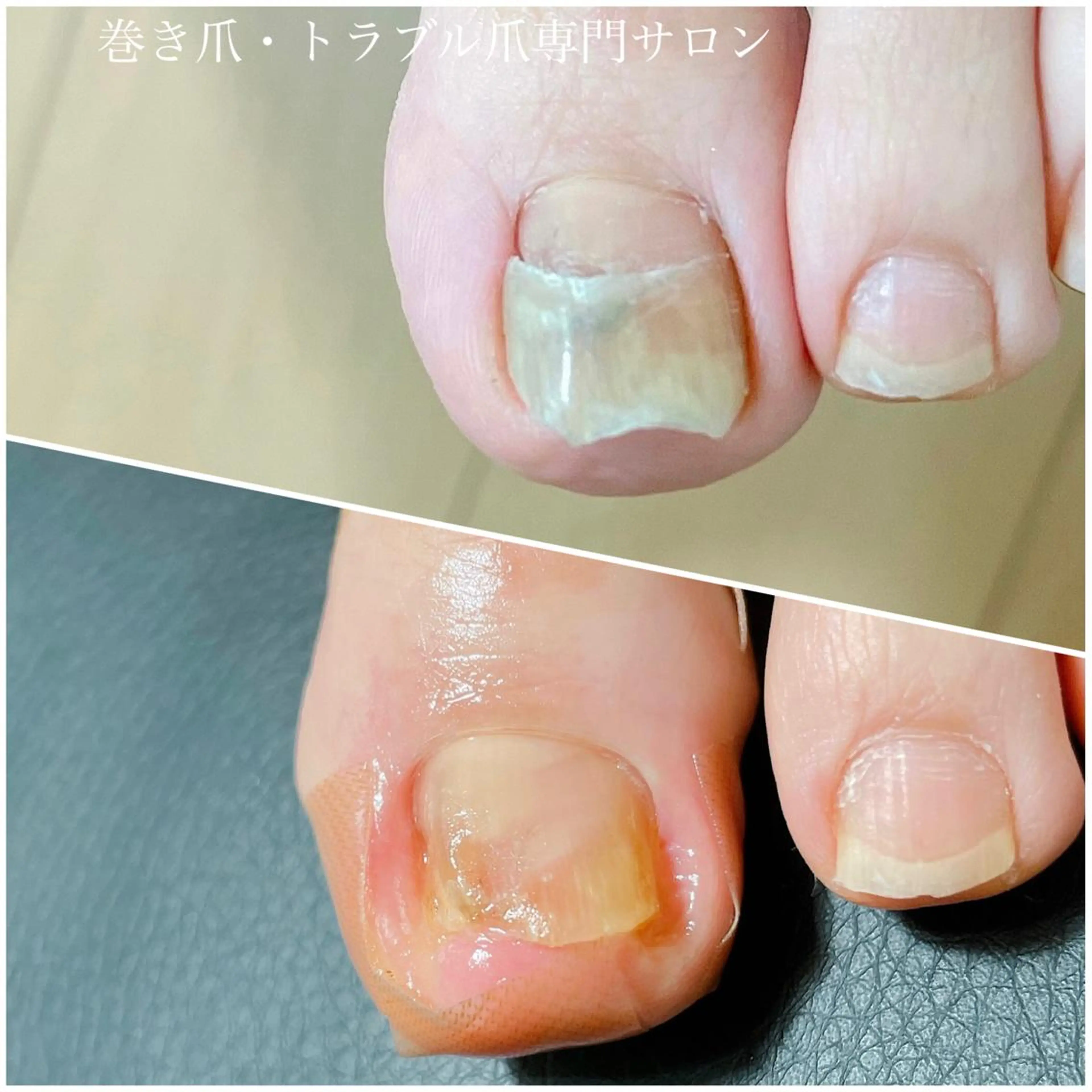 ネイル 深爪・巻き爪 専門サンセリテのネイルデザイン