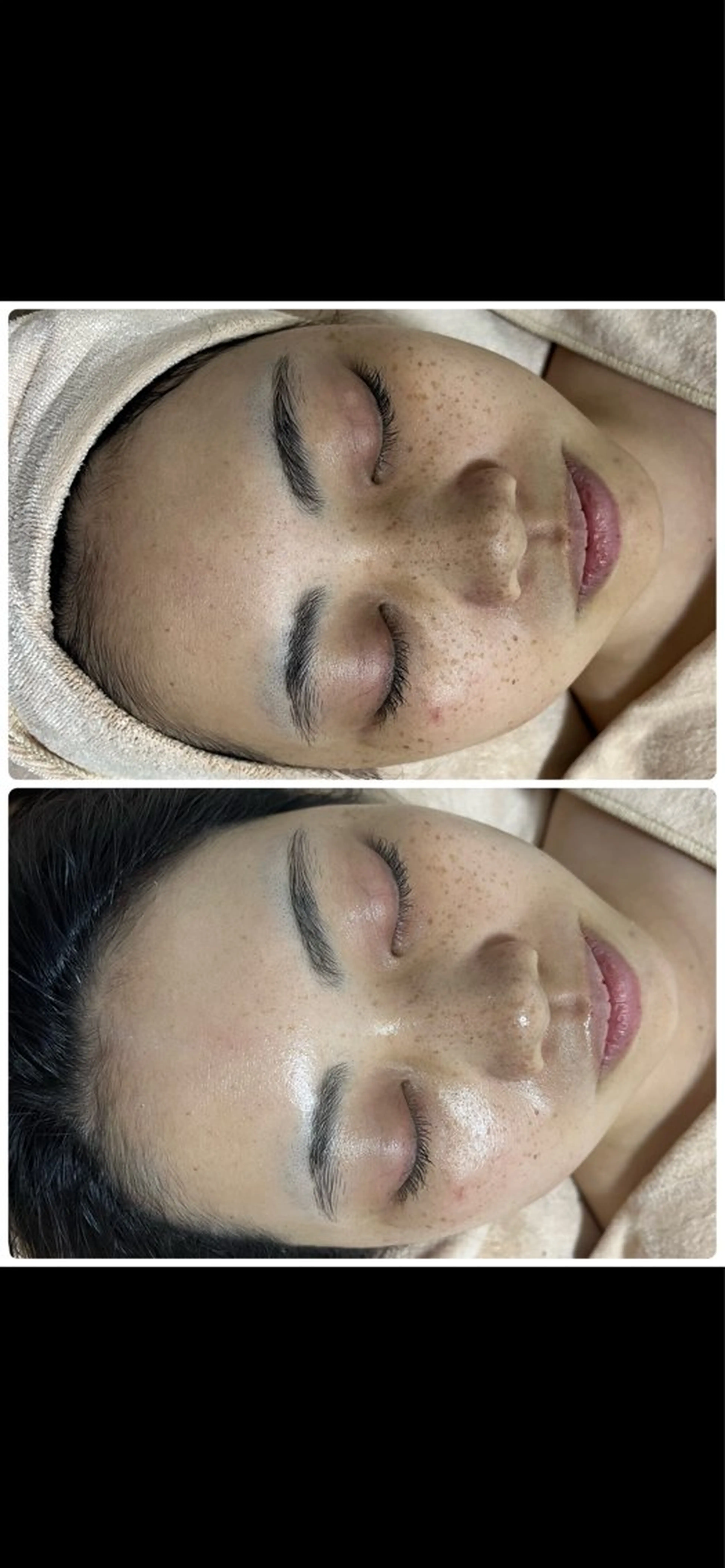 ニキビ／毛穴ケア ハーブピーリングのエステ・リラクイメージ