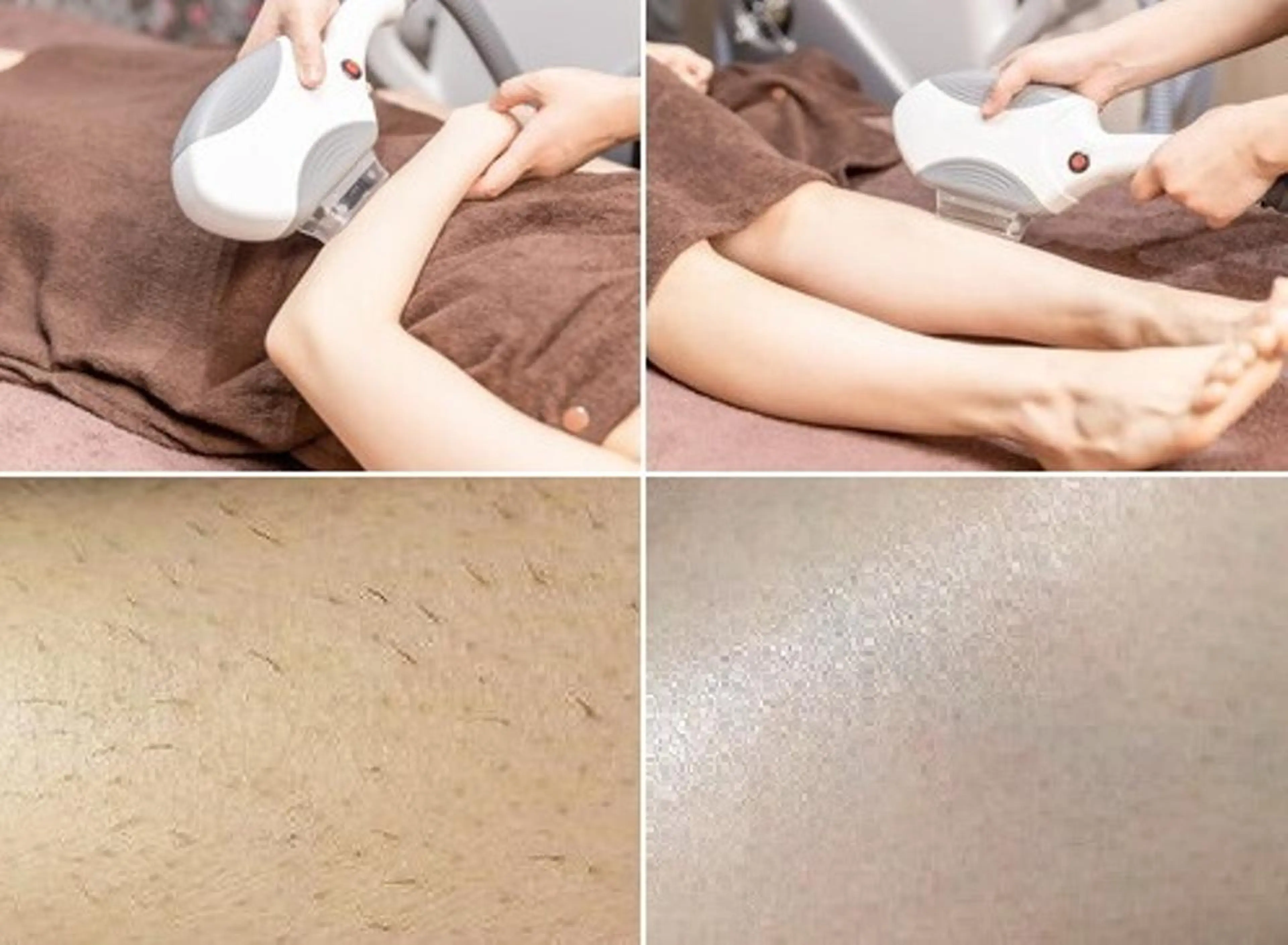 ♪脱毛初心者♪【美療ひじ下+ひざ下脱毛】圧倒的にキレイ、経済的に完了の写真