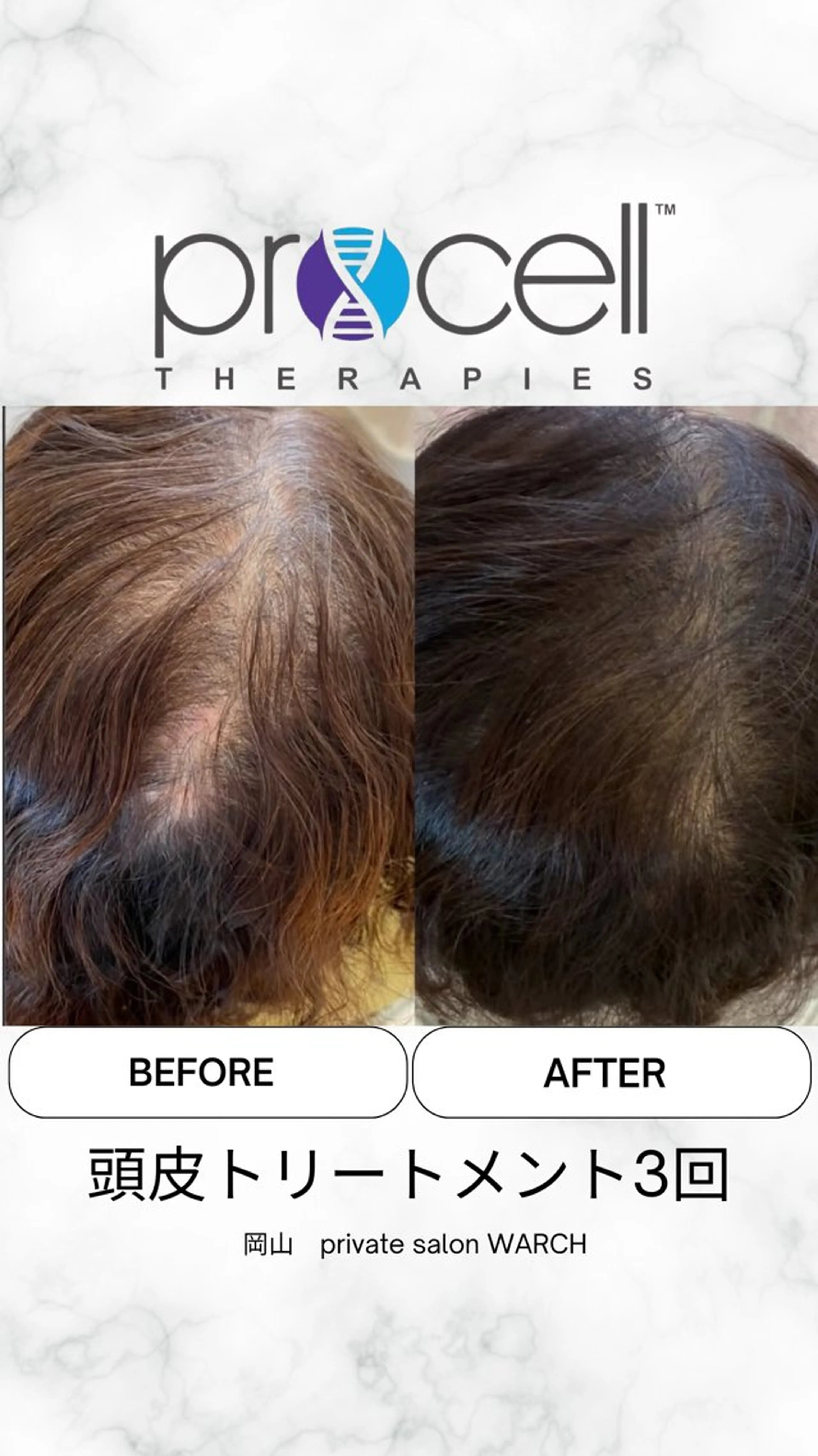 【本気の育毛促進】プロセル頭皮（産後抜け毛・びまん性）￥50,000→￥40,000の写真