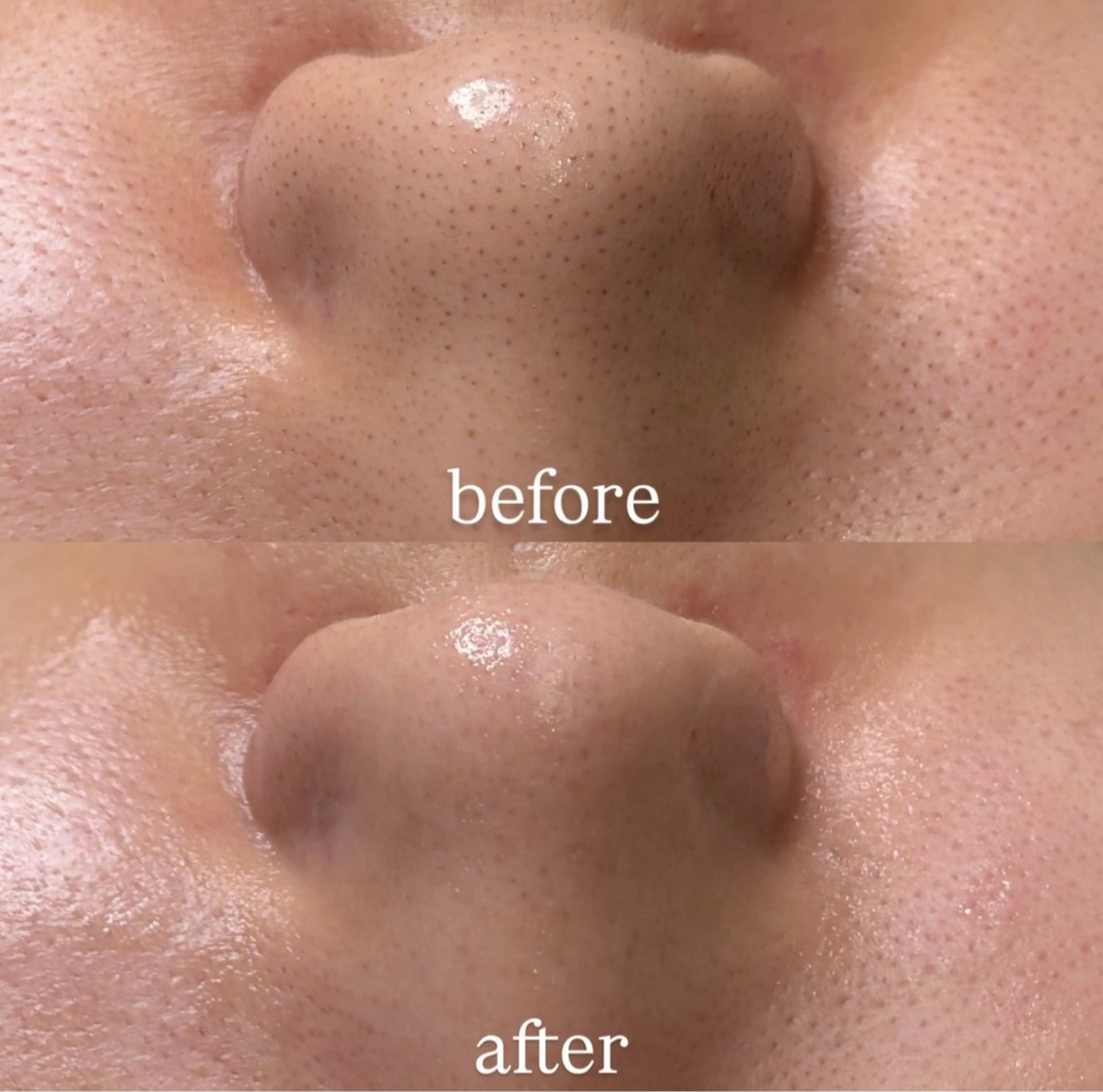 毛穴洗浄の写真